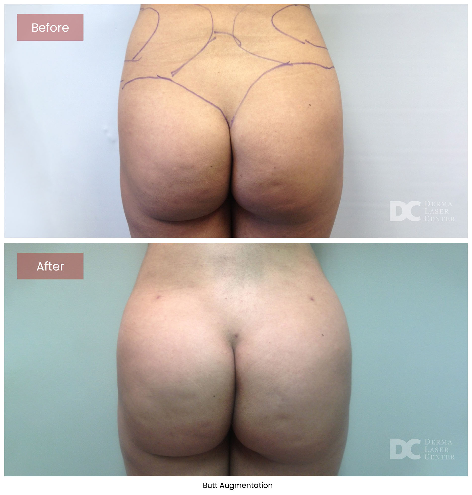 before after butt augmentation 1