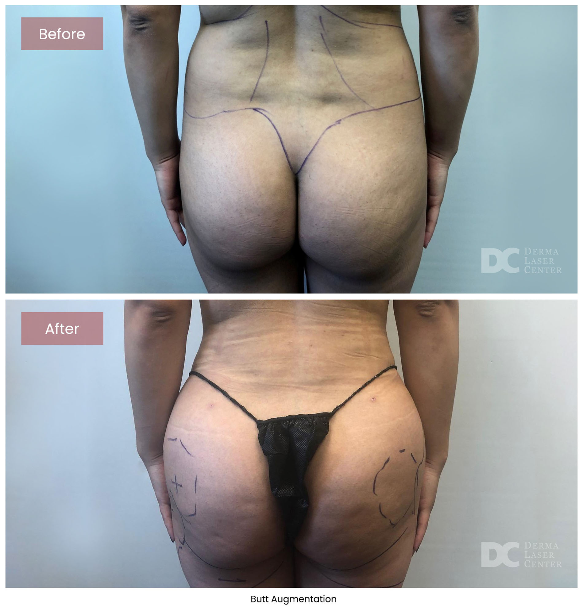 before after butt augmentation 2