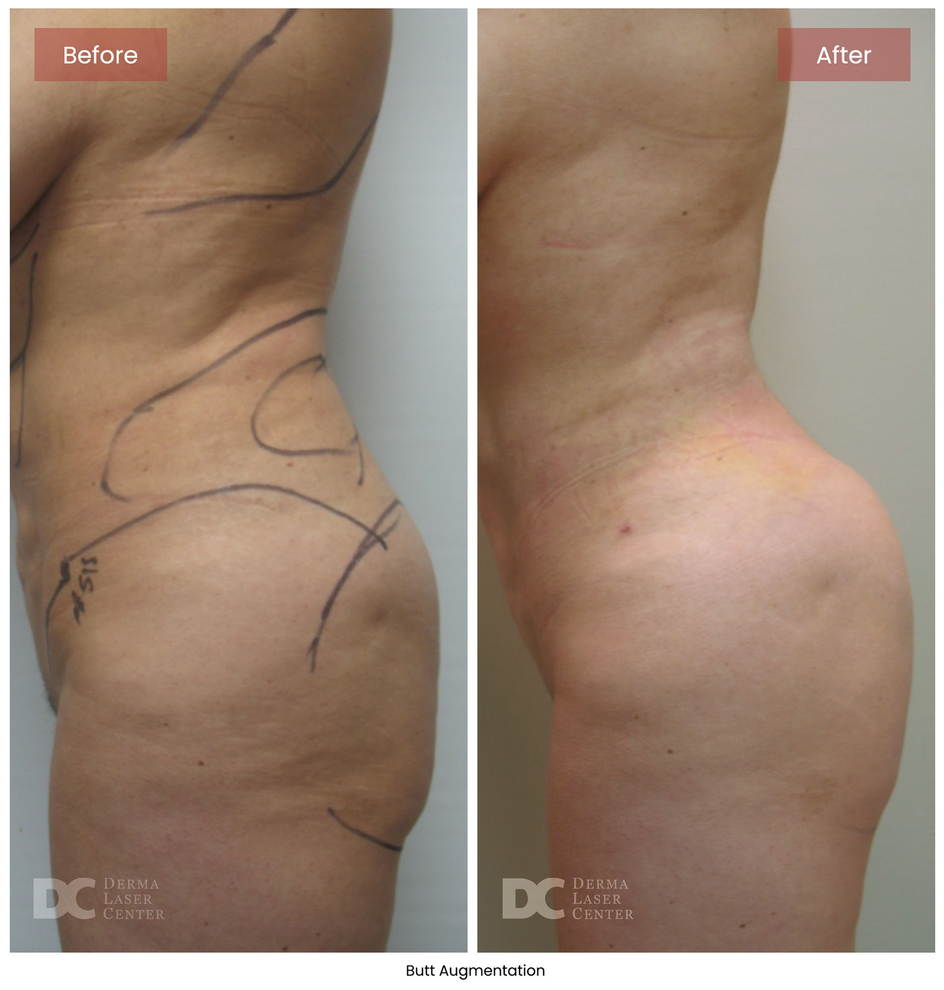 before after butt augmentation 3
