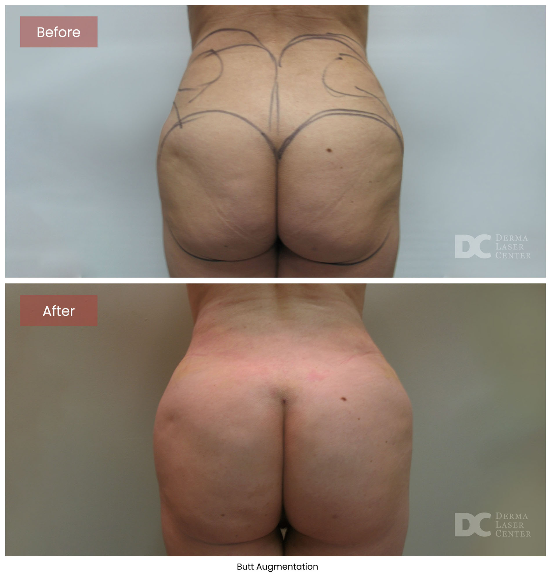 before after butt augmentation 4
