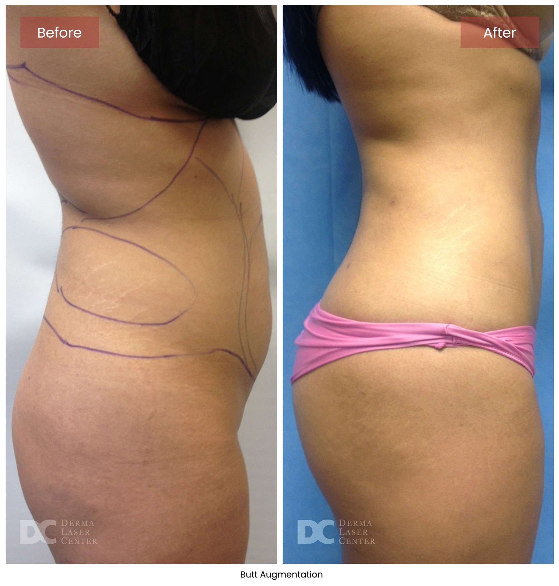 before after butt augmentation 5