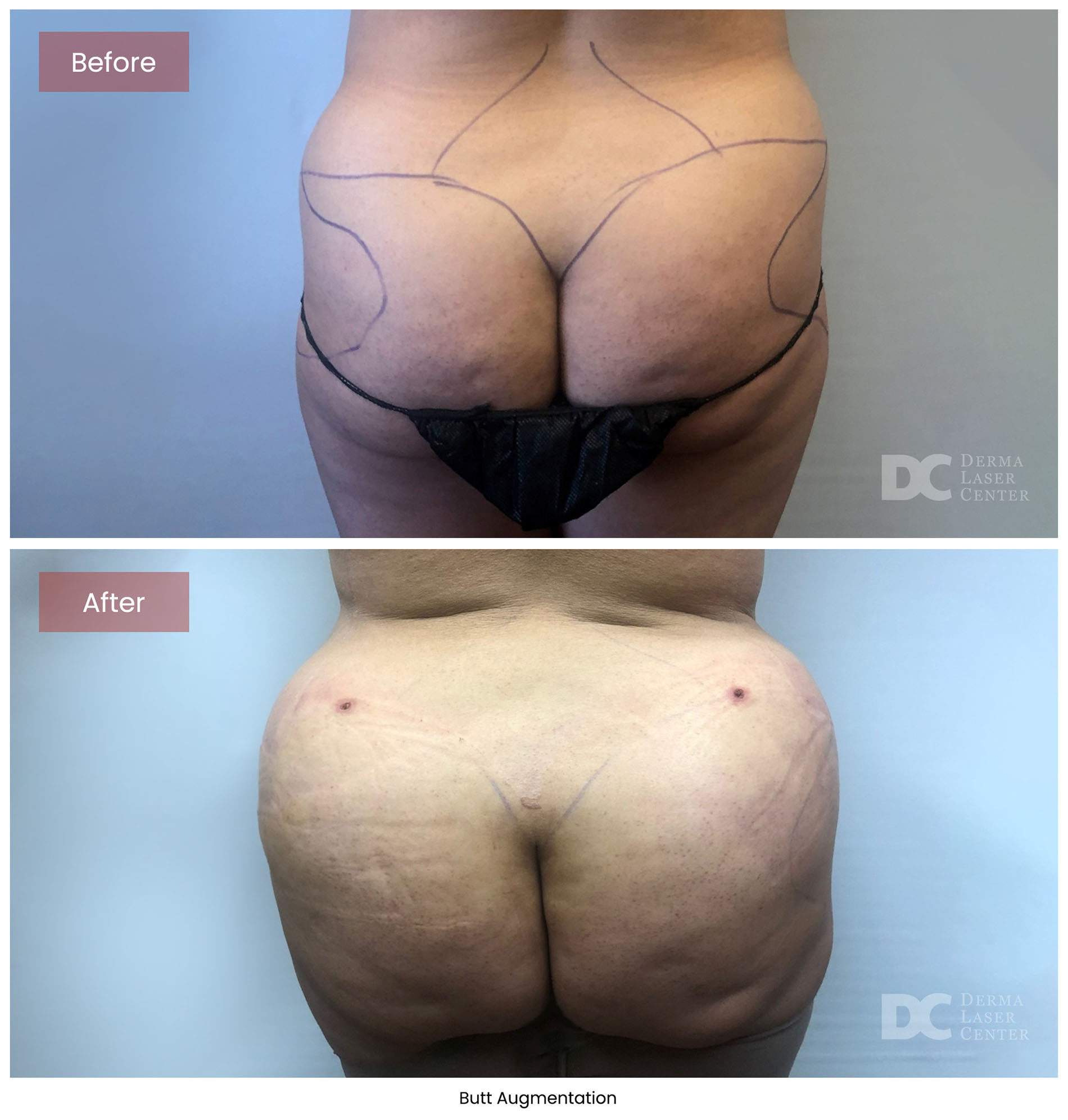 before after butt augmentation 7