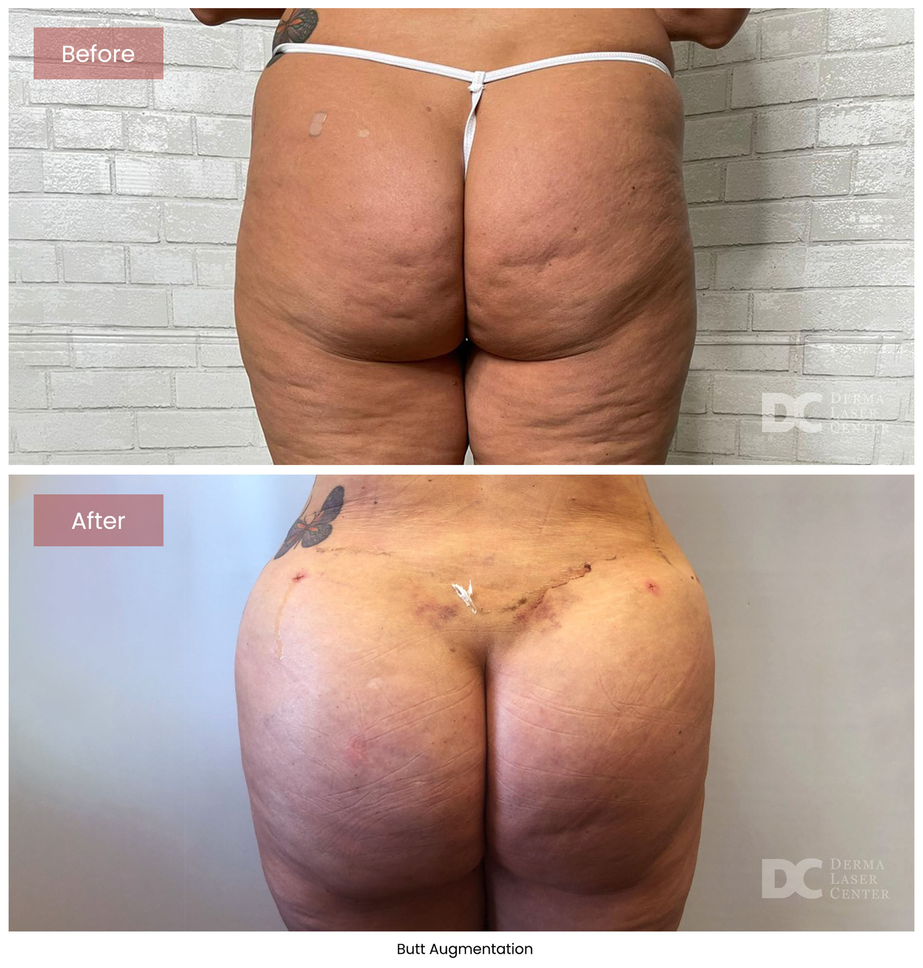 before after butt augmentation 8