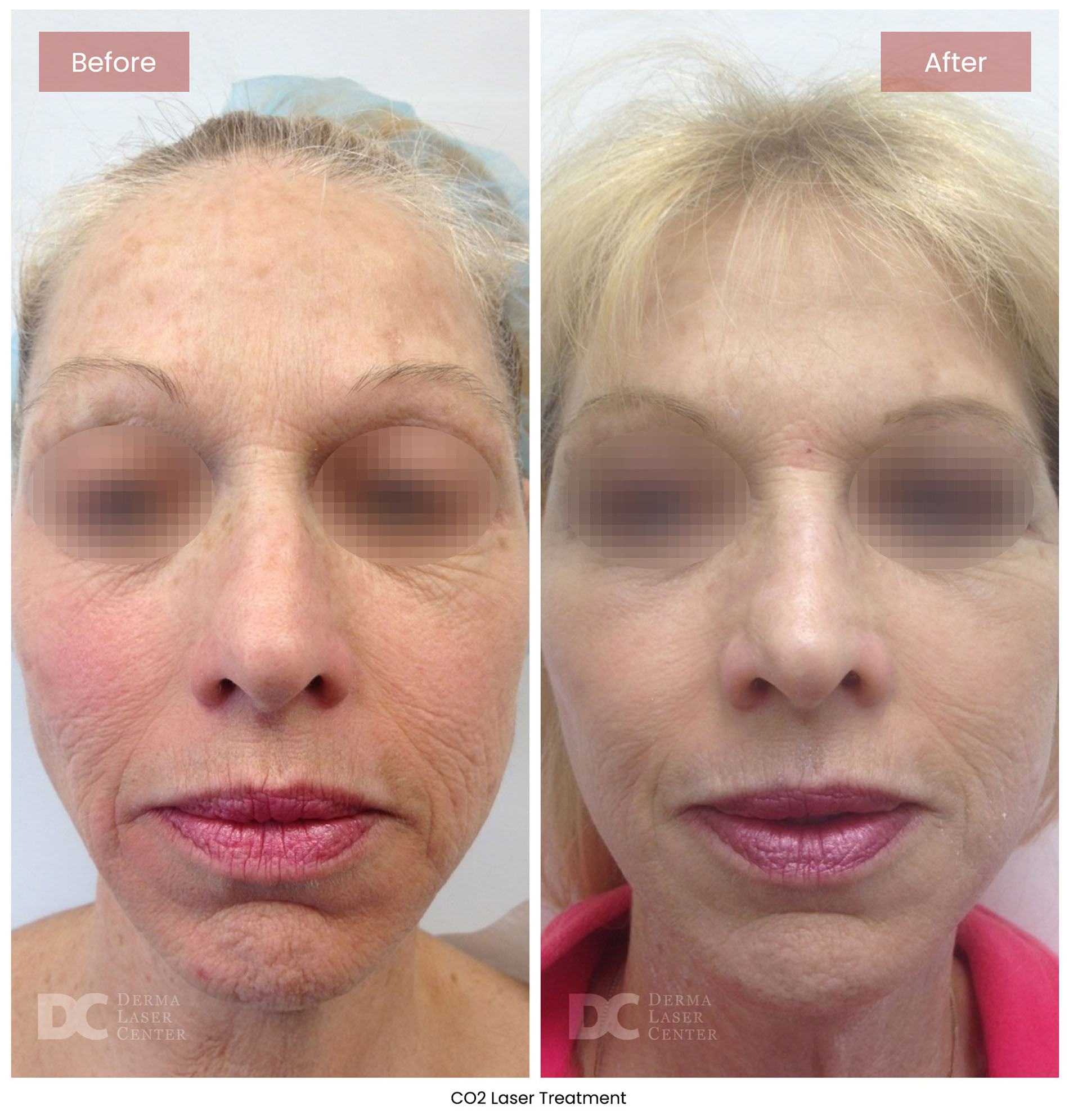Before After CO2 Laser 10