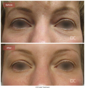 CO2 Laser Before and After Pictures | Derma Laser Center