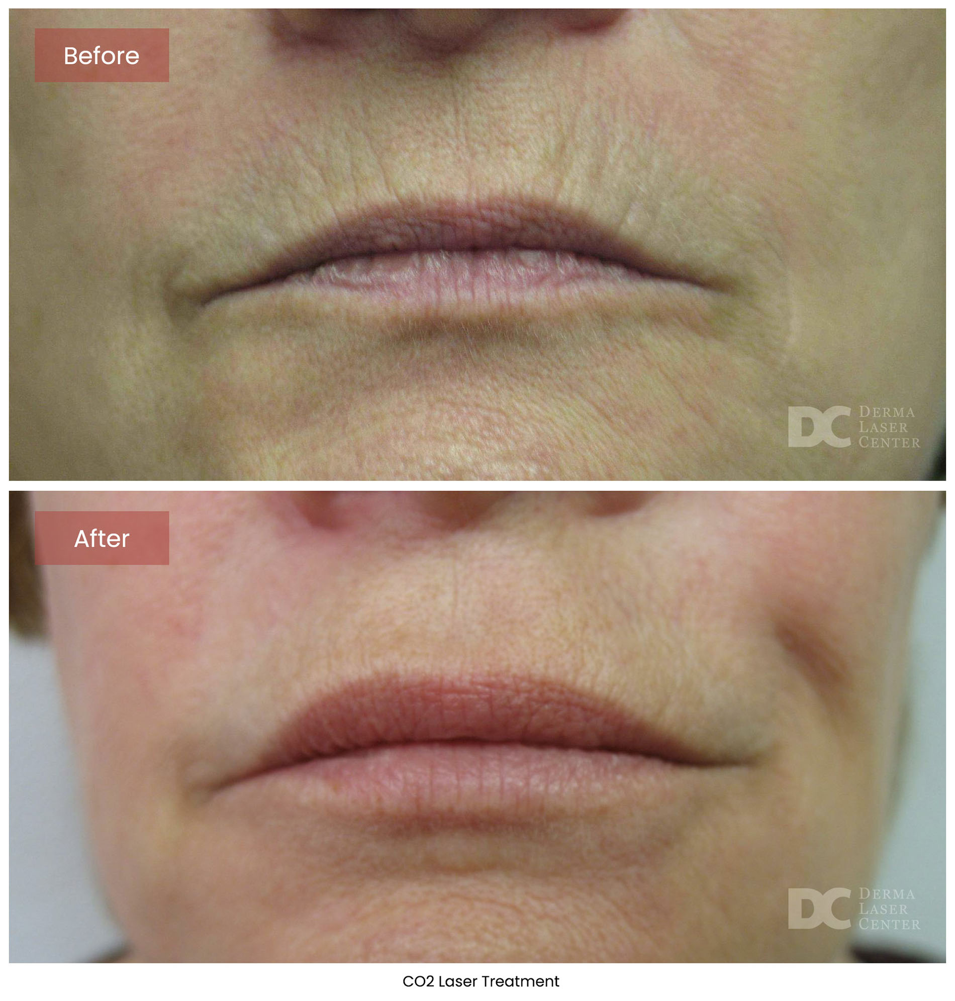 Before After CO2 Laser 2