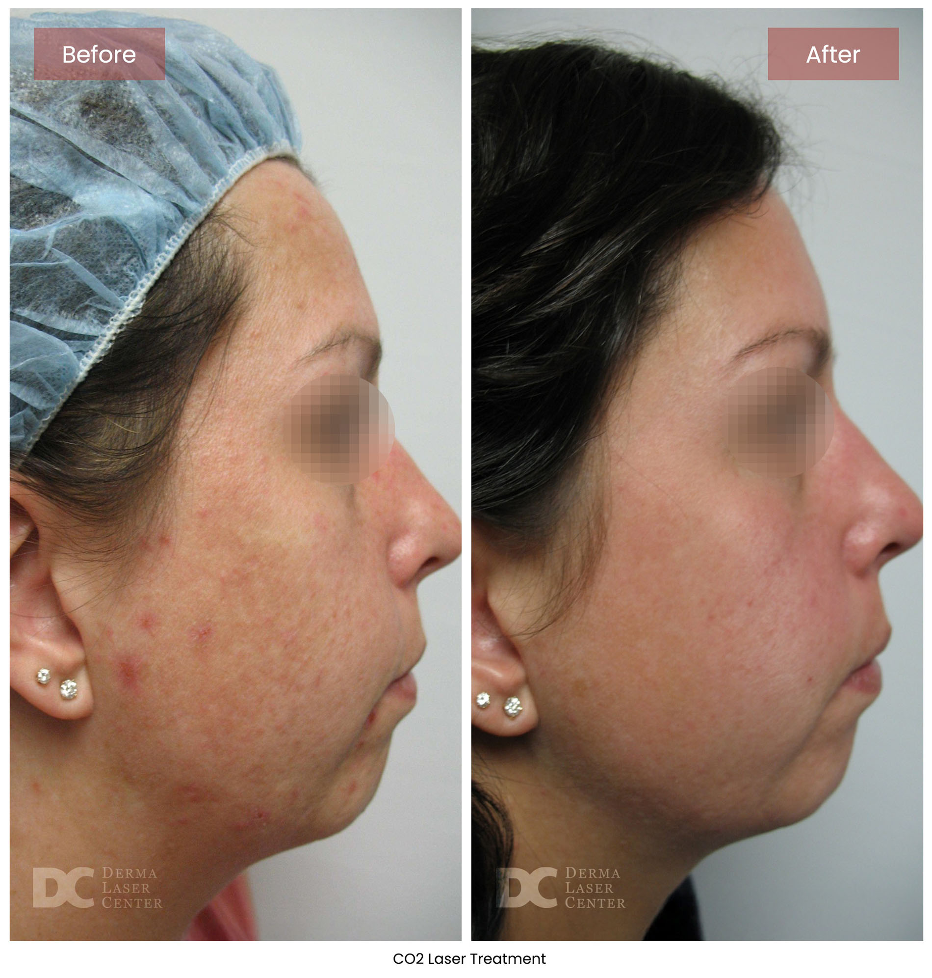 Before After CO2 Laser 3