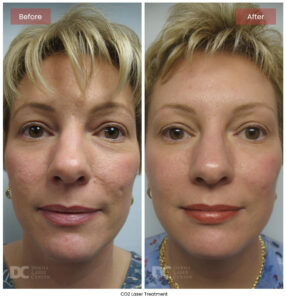 CO2 Laser Before and After Pictures | Derma Laser Center
