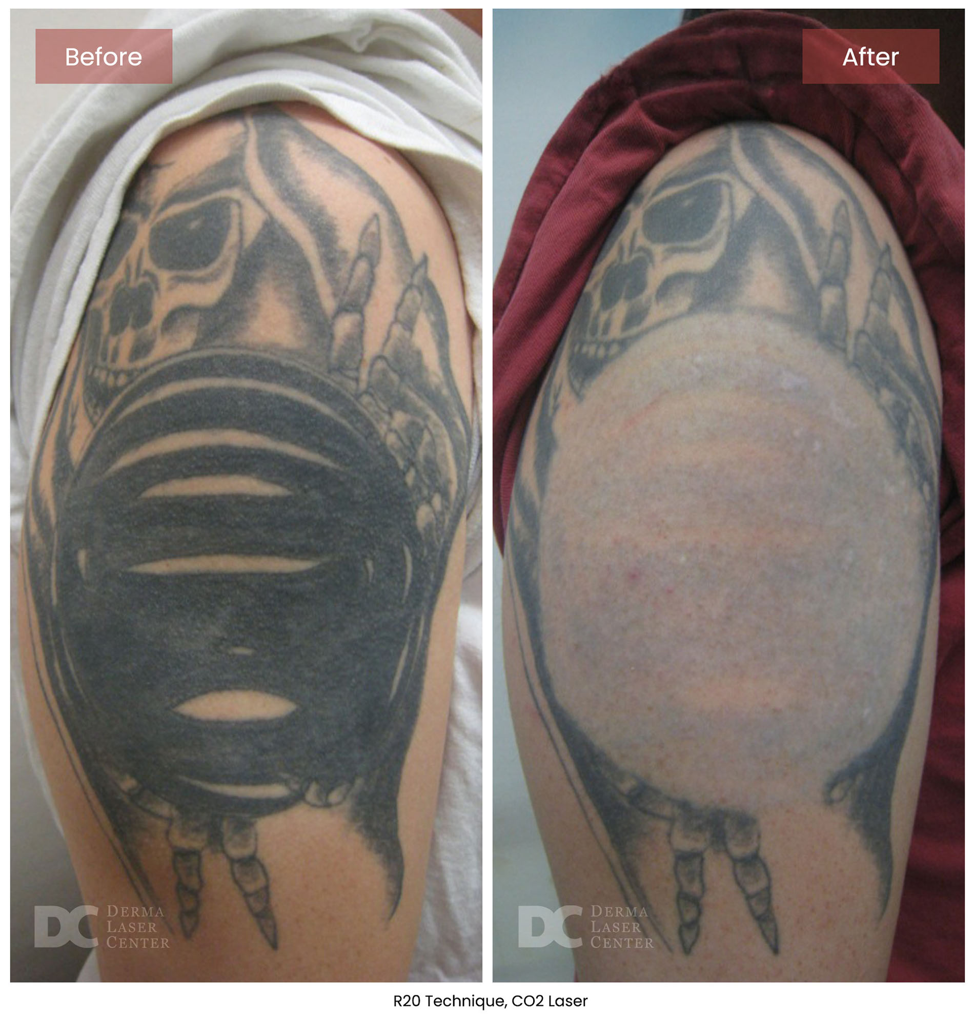 Before After CO2 Laser 8