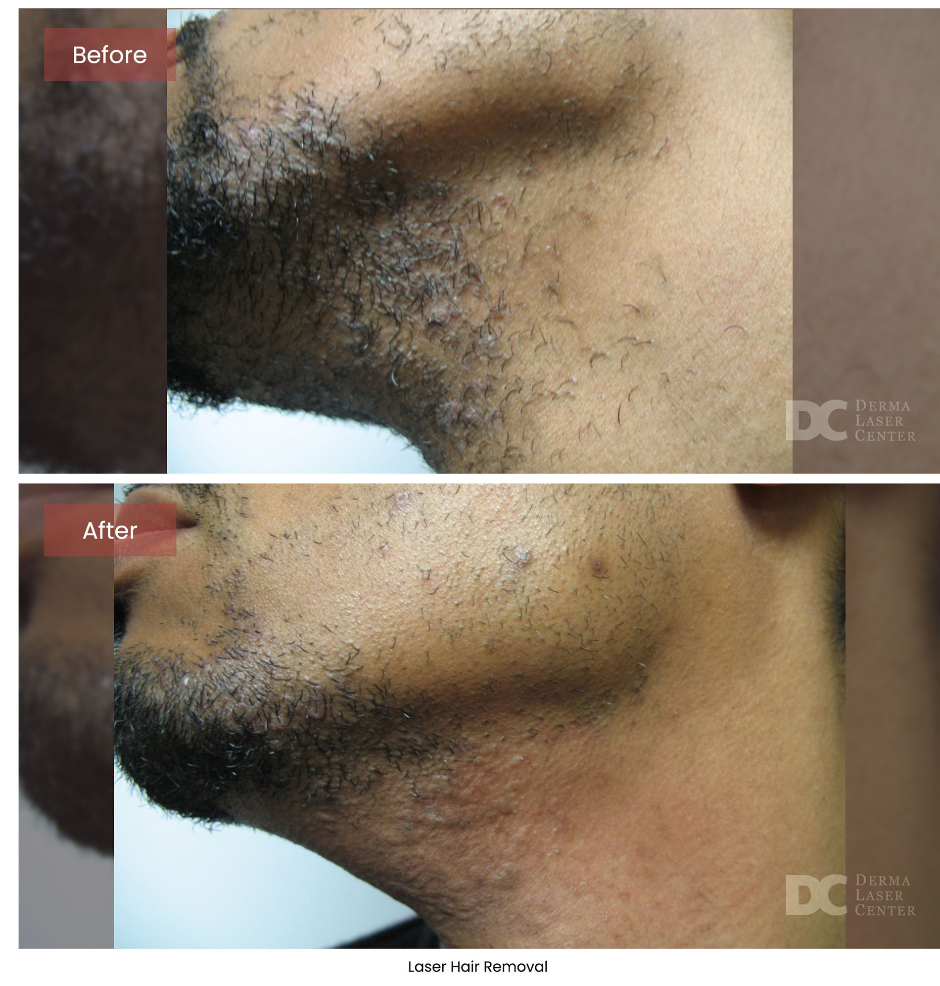 before after hair removal 1