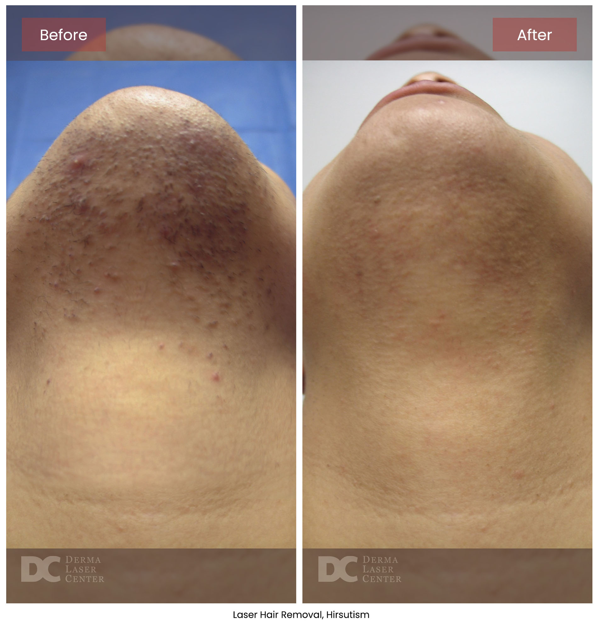 before after hair removal 2