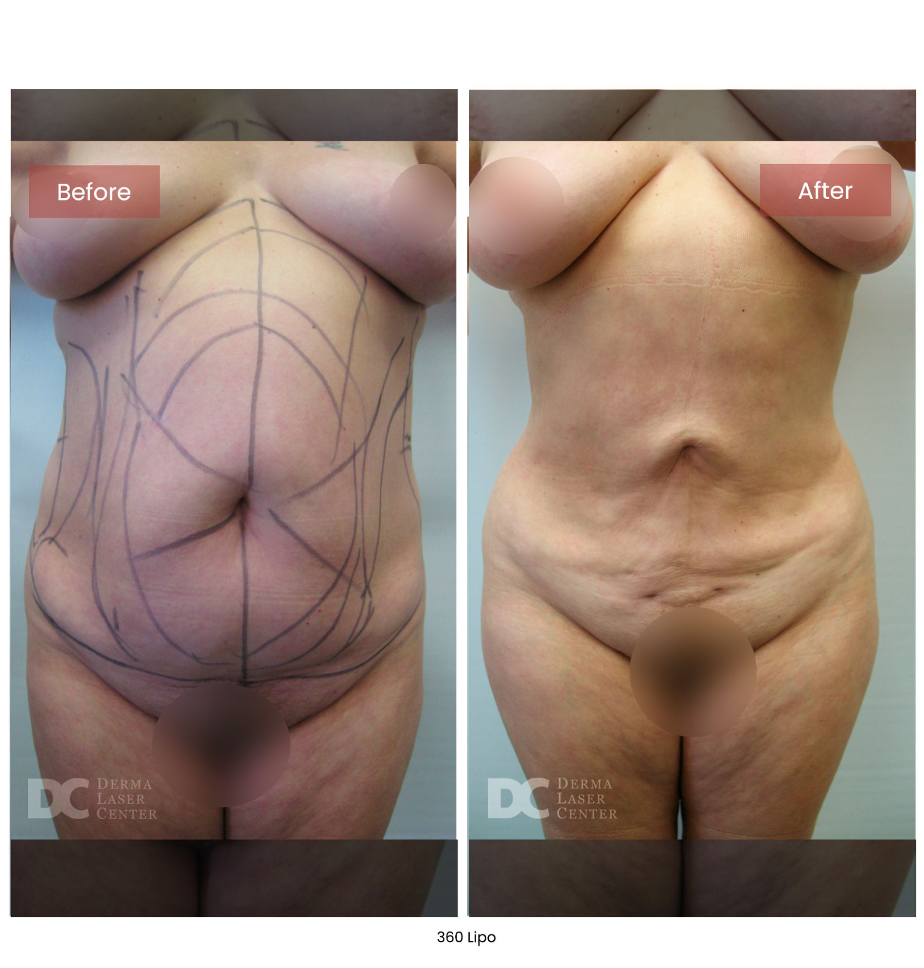 Before After Lipo 12