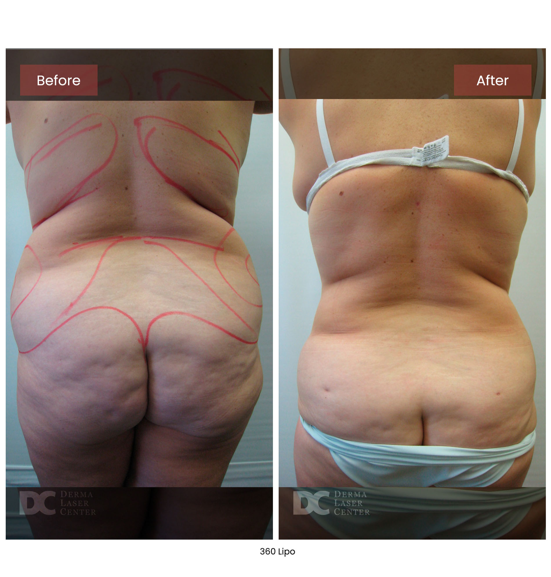 Before After Lipo 15
