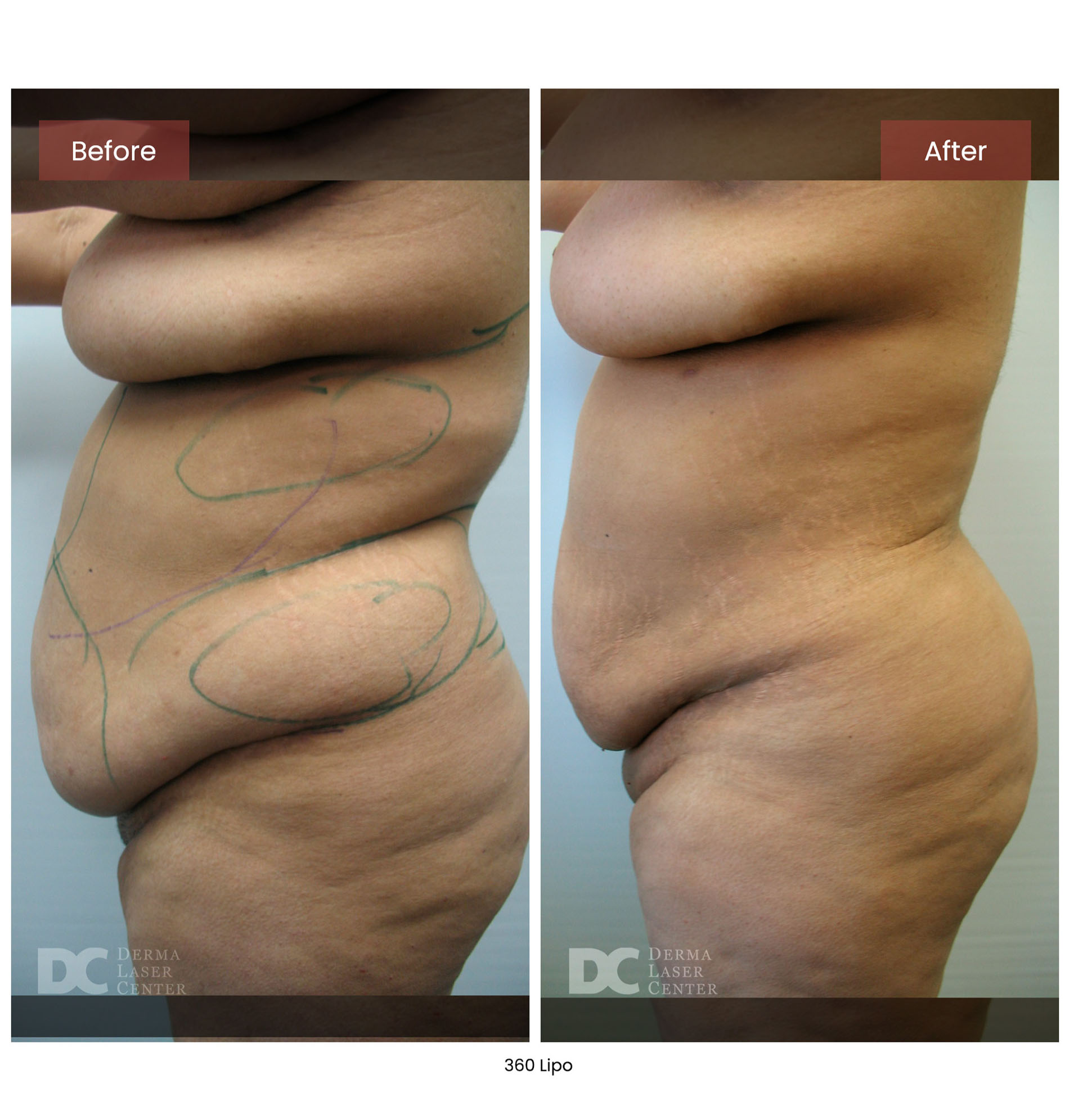 Before After Lipo 17