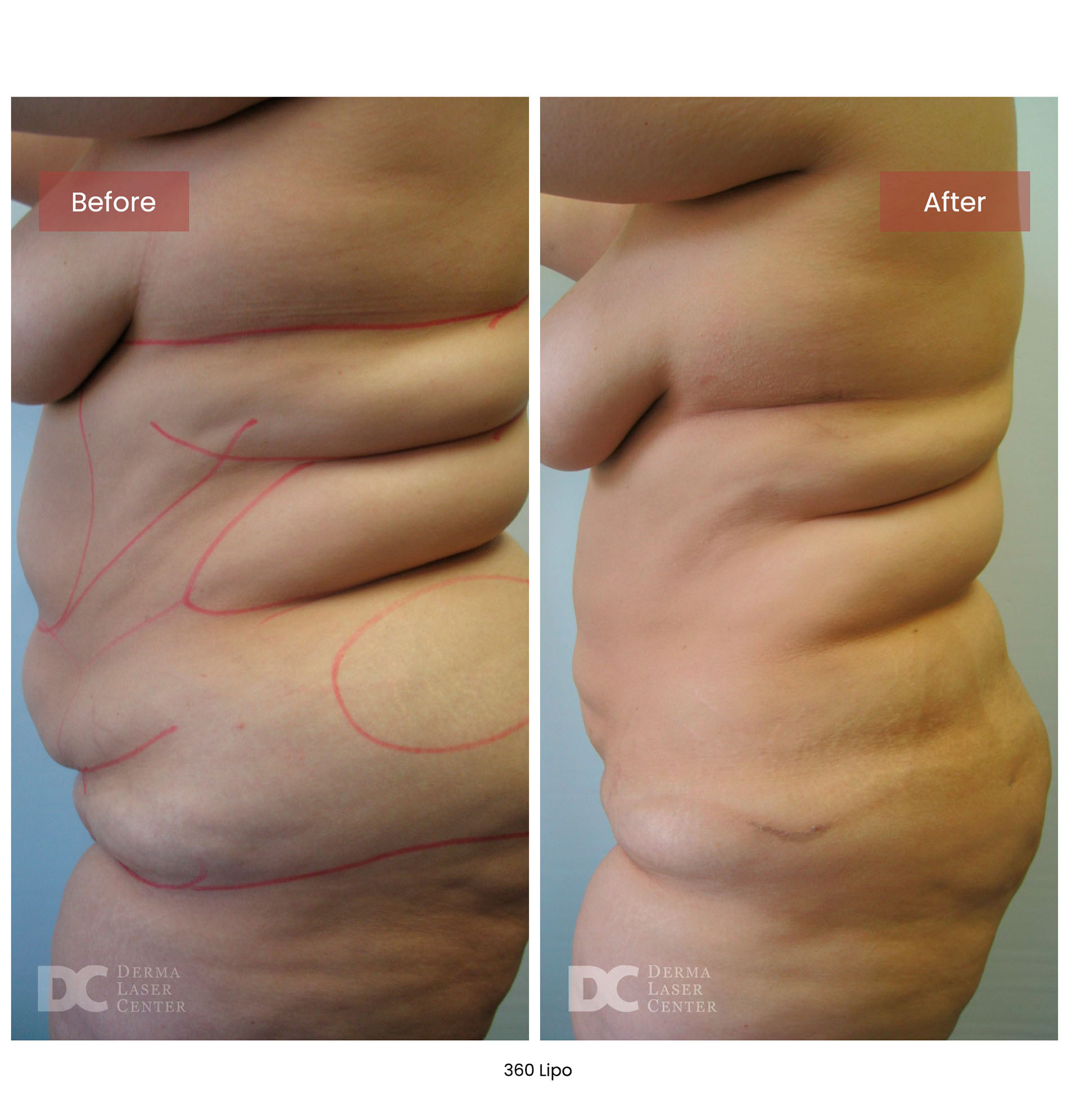 Before After Lipo 18