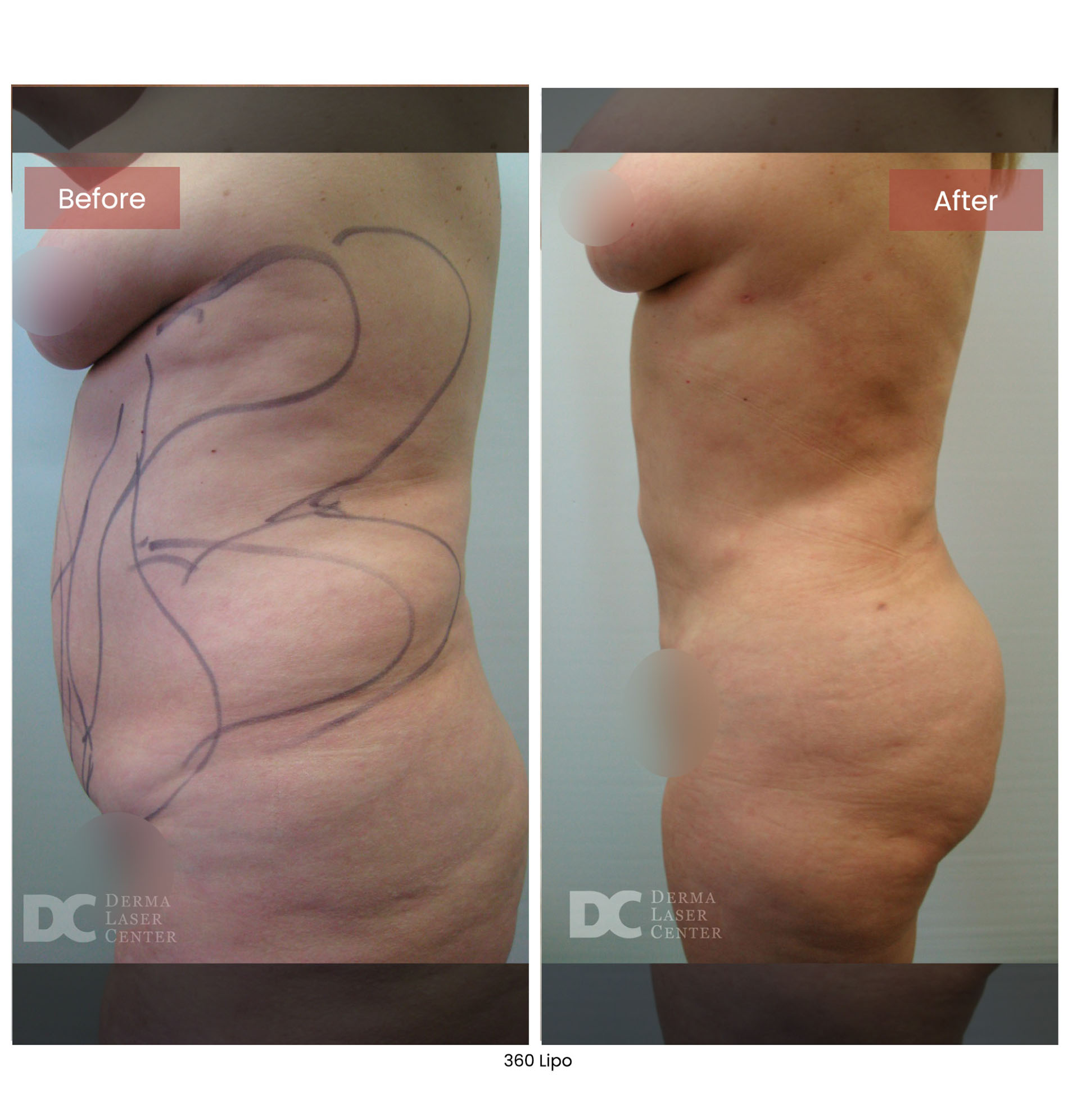 Before After Lipo 2