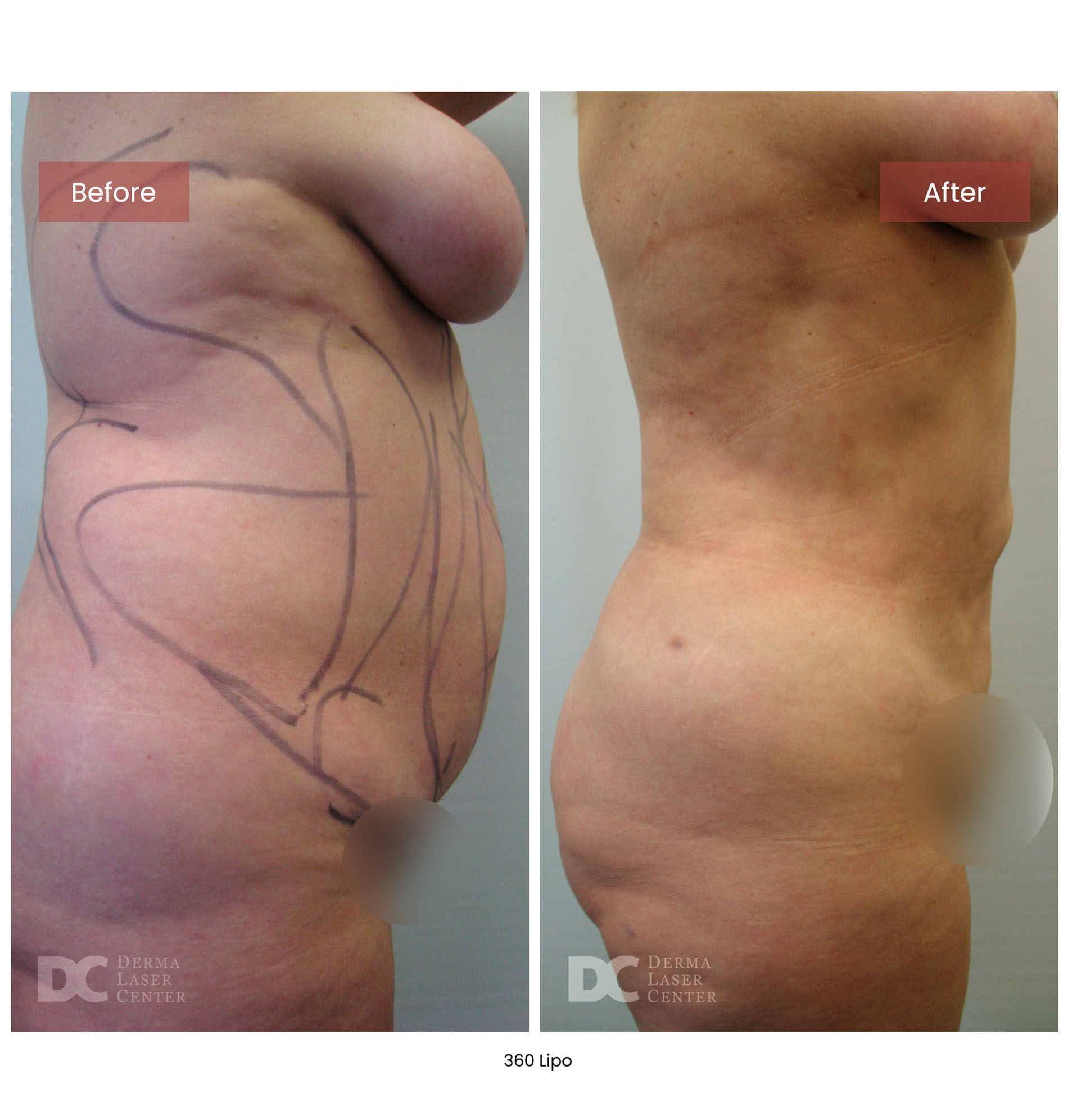 Before After Lipo 3