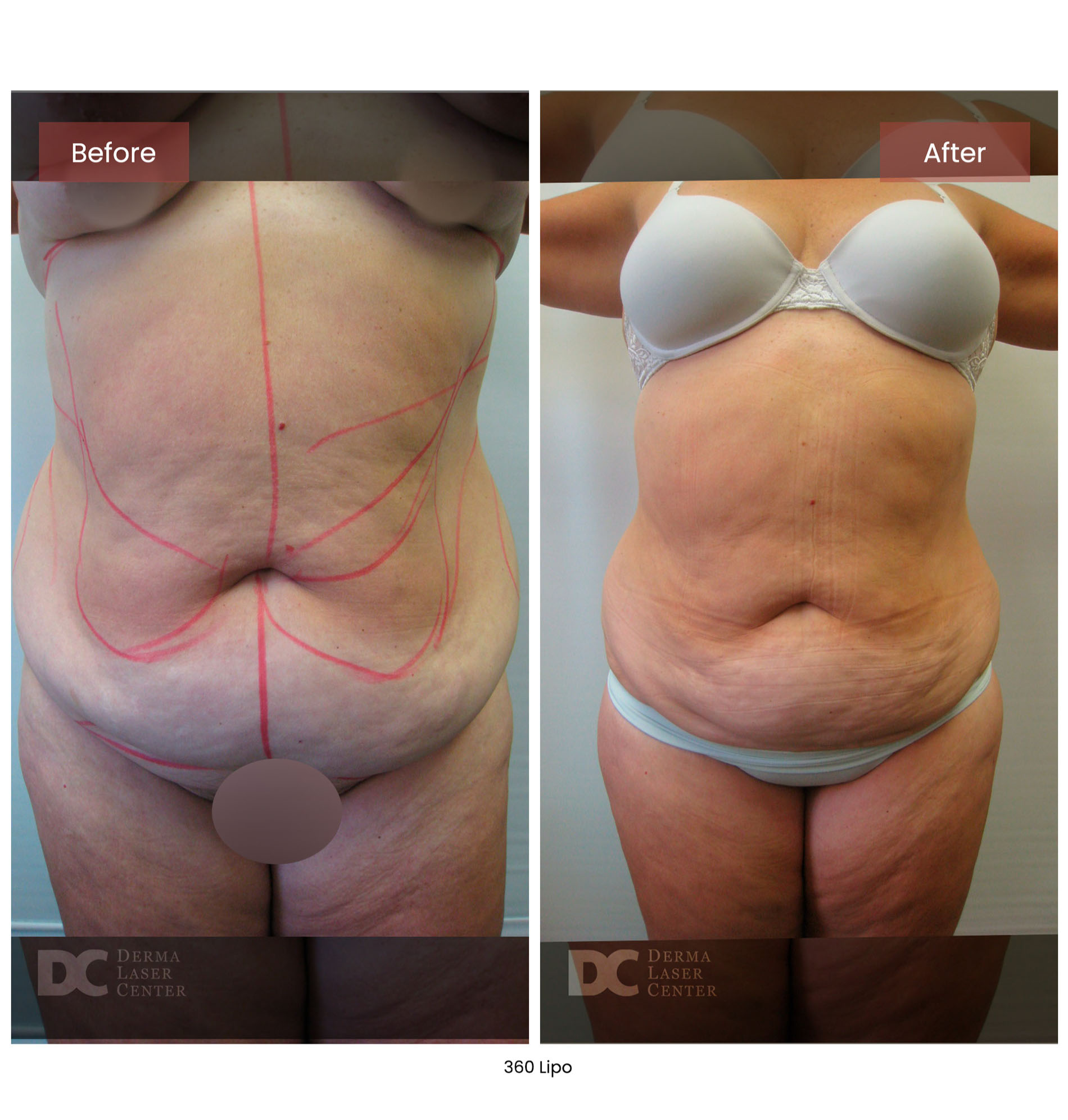 before after lipo 360 10