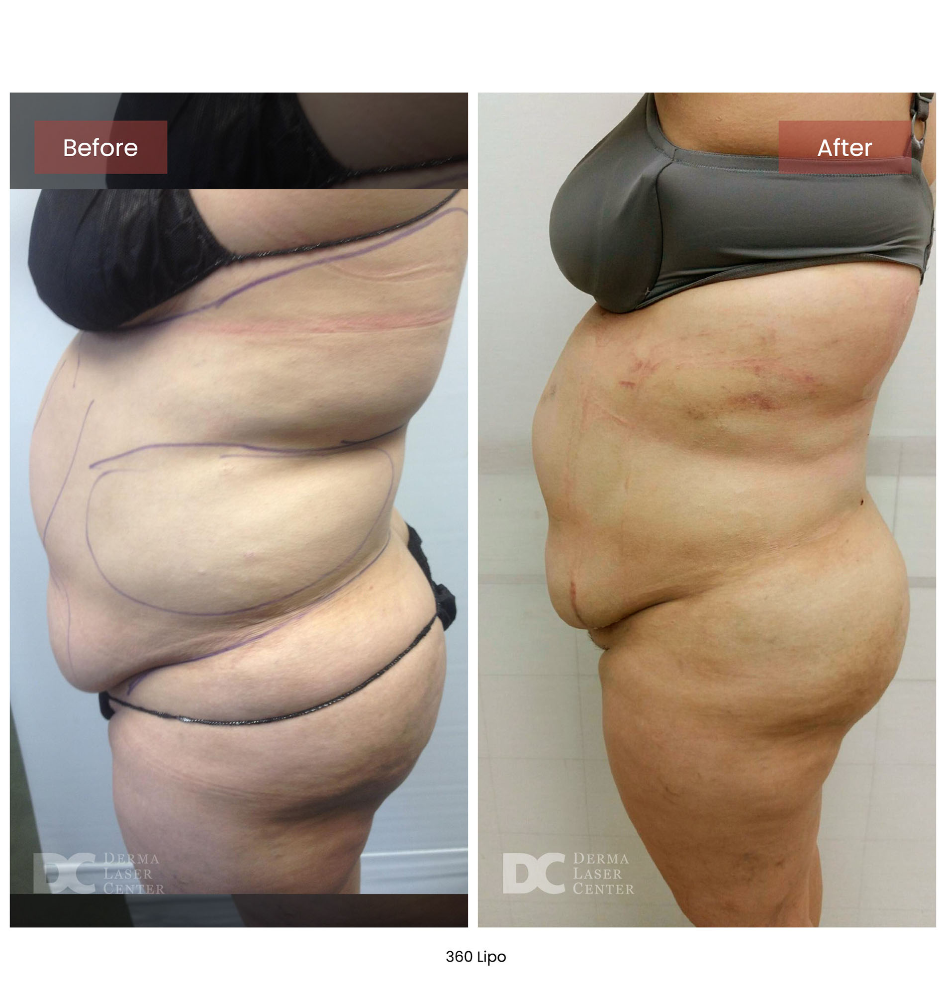 before after lipo 360 12