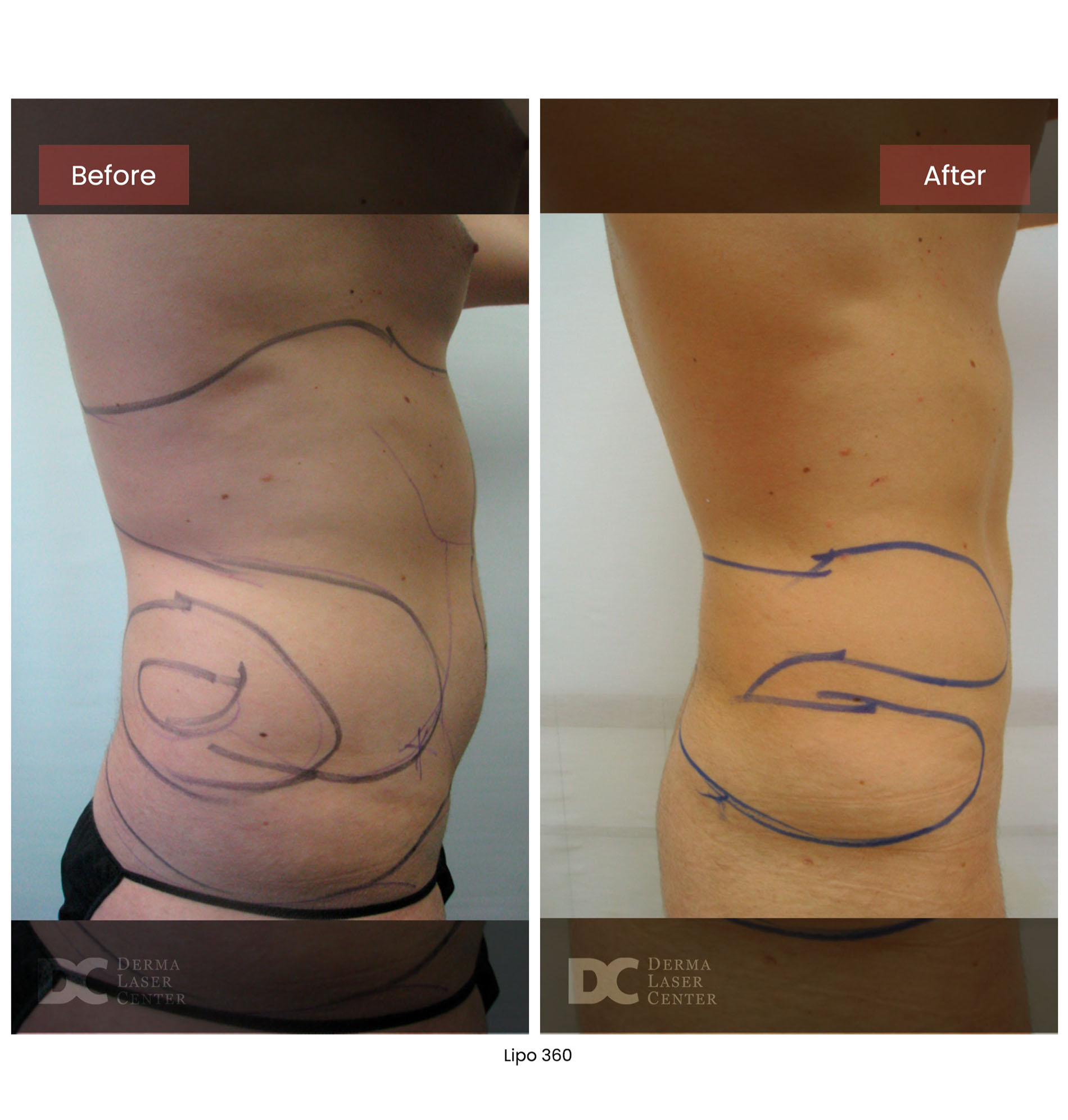 before after lipo 360 15