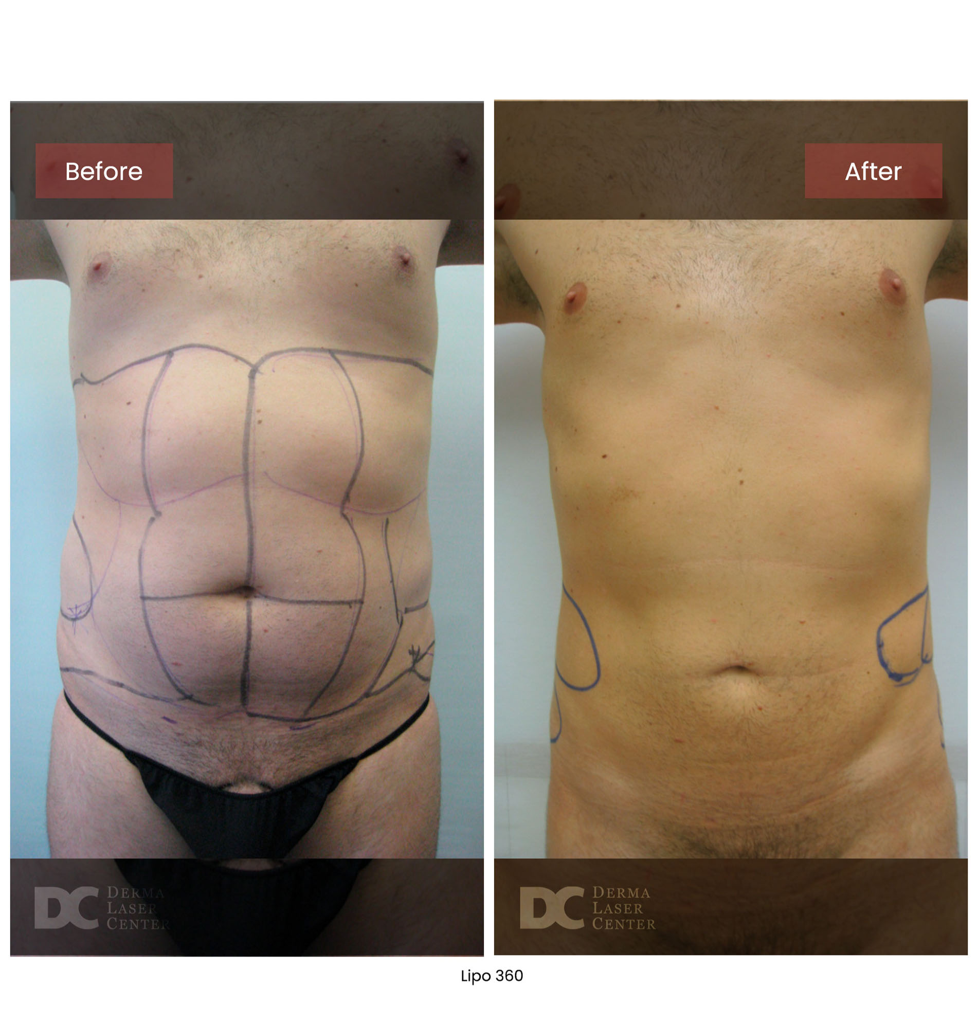 before after lipo 360 16