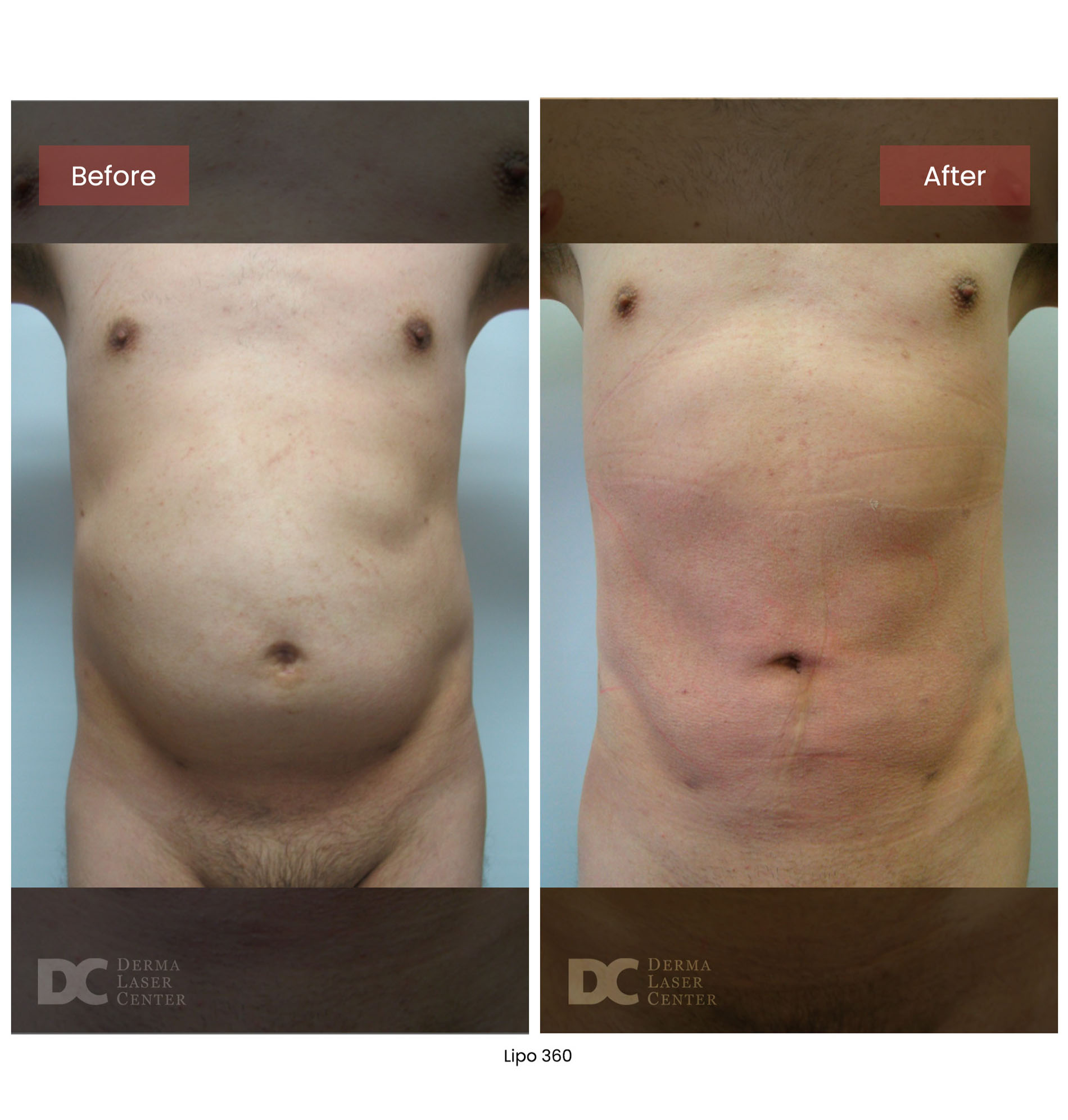 before after lipo 360 17