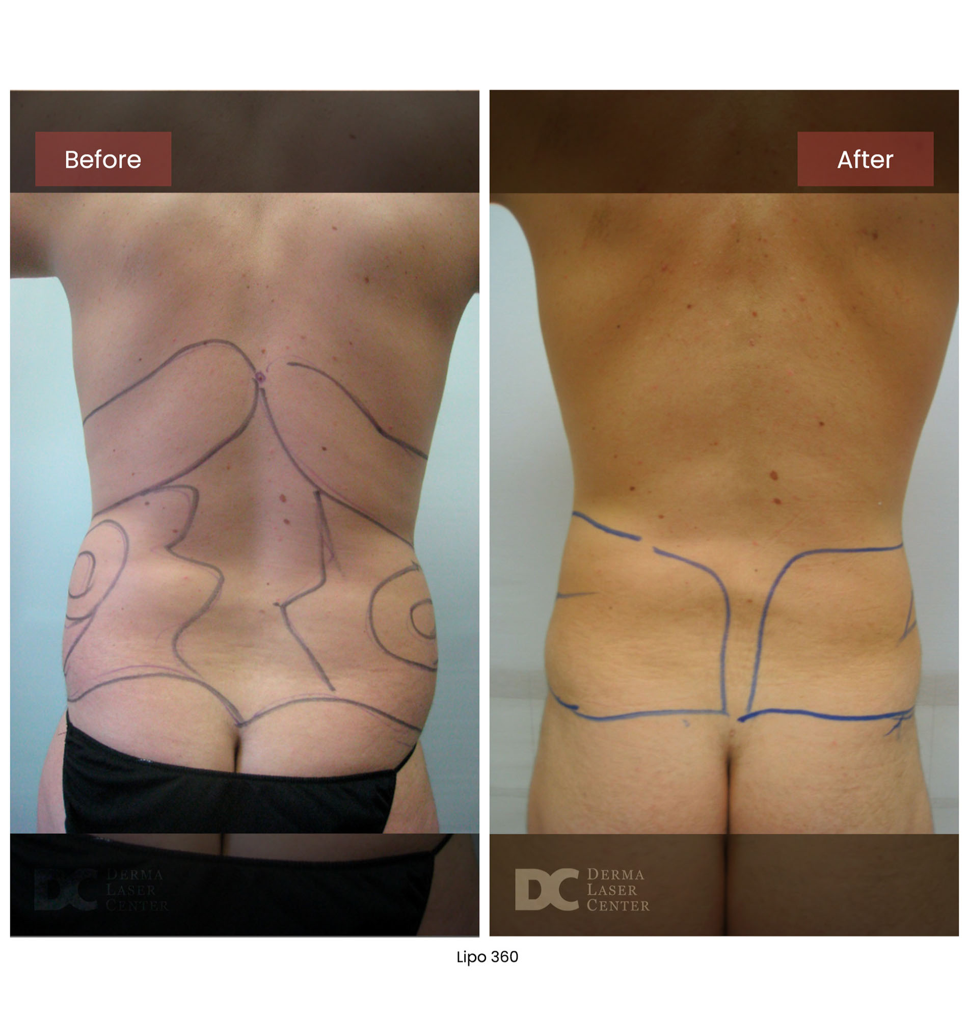 before after lipo 360 18