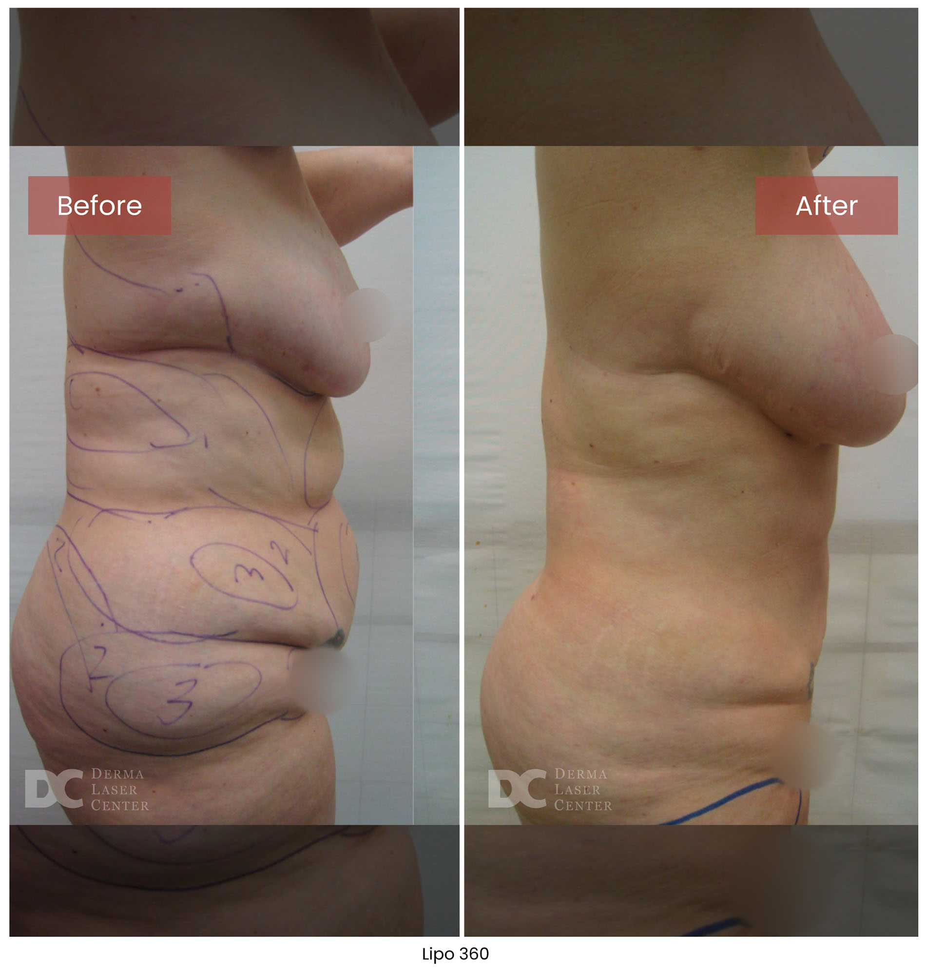 before after lipo 360 19