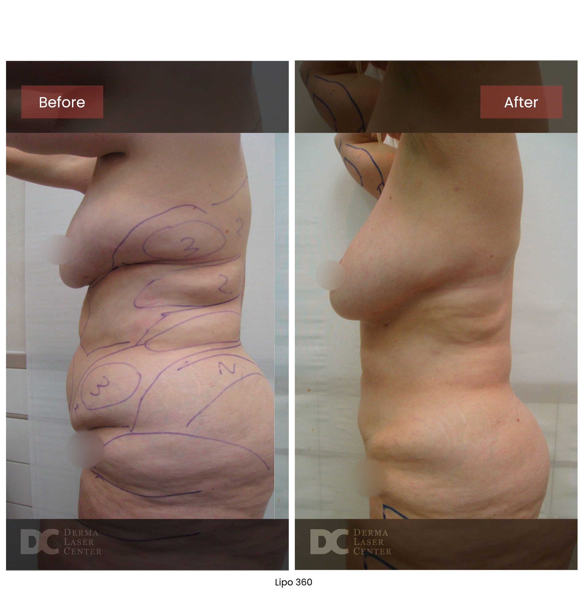 before after lipo 360 20