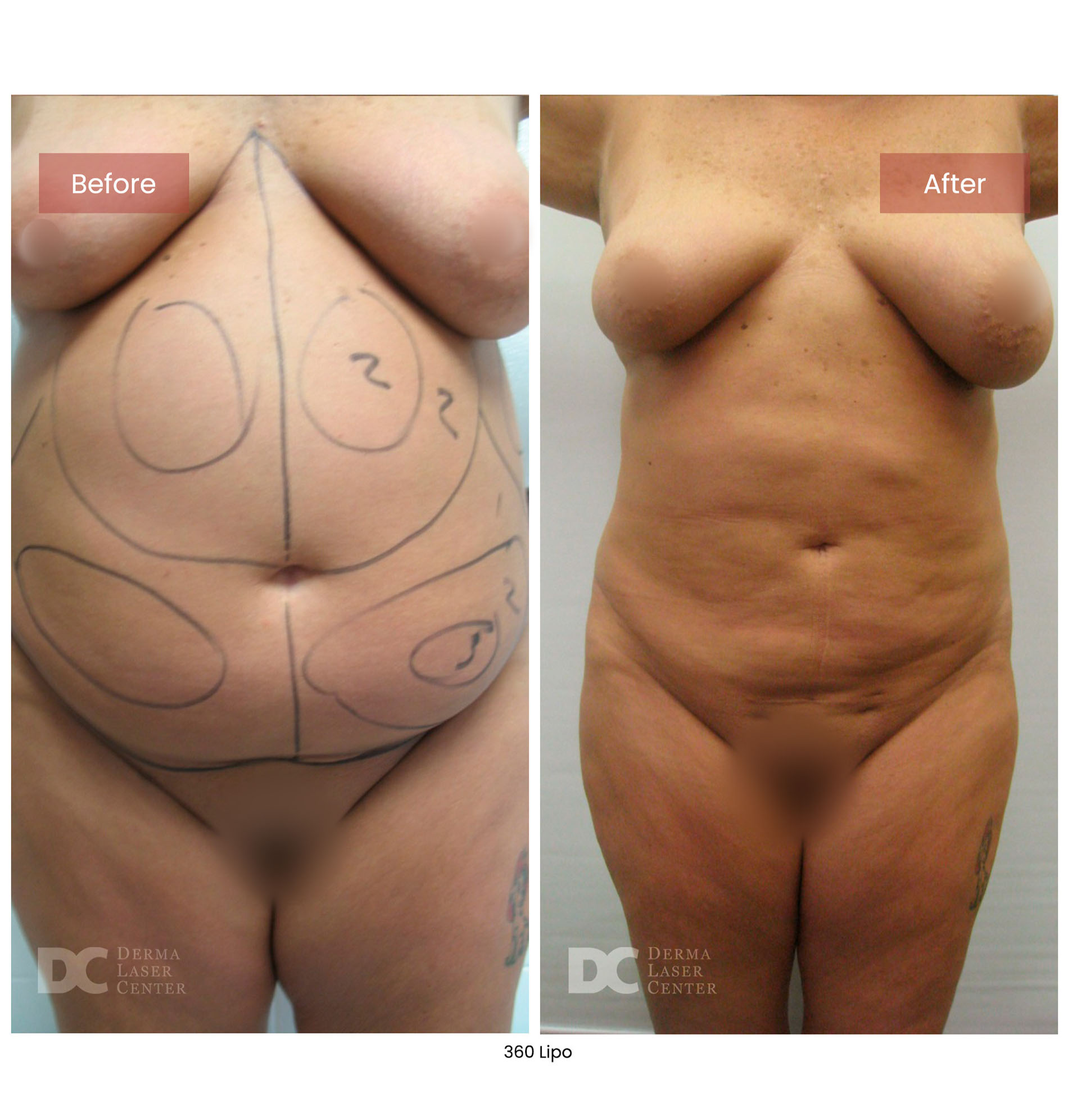 before after lipo 360 4
