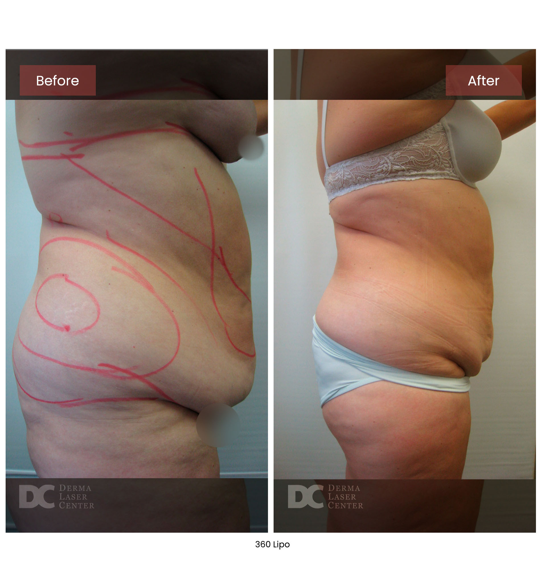 before after lipo 360 5