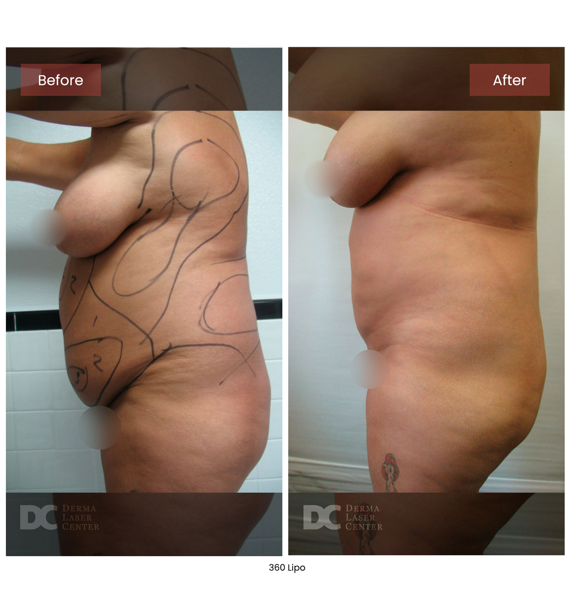 before after lipo 360 6