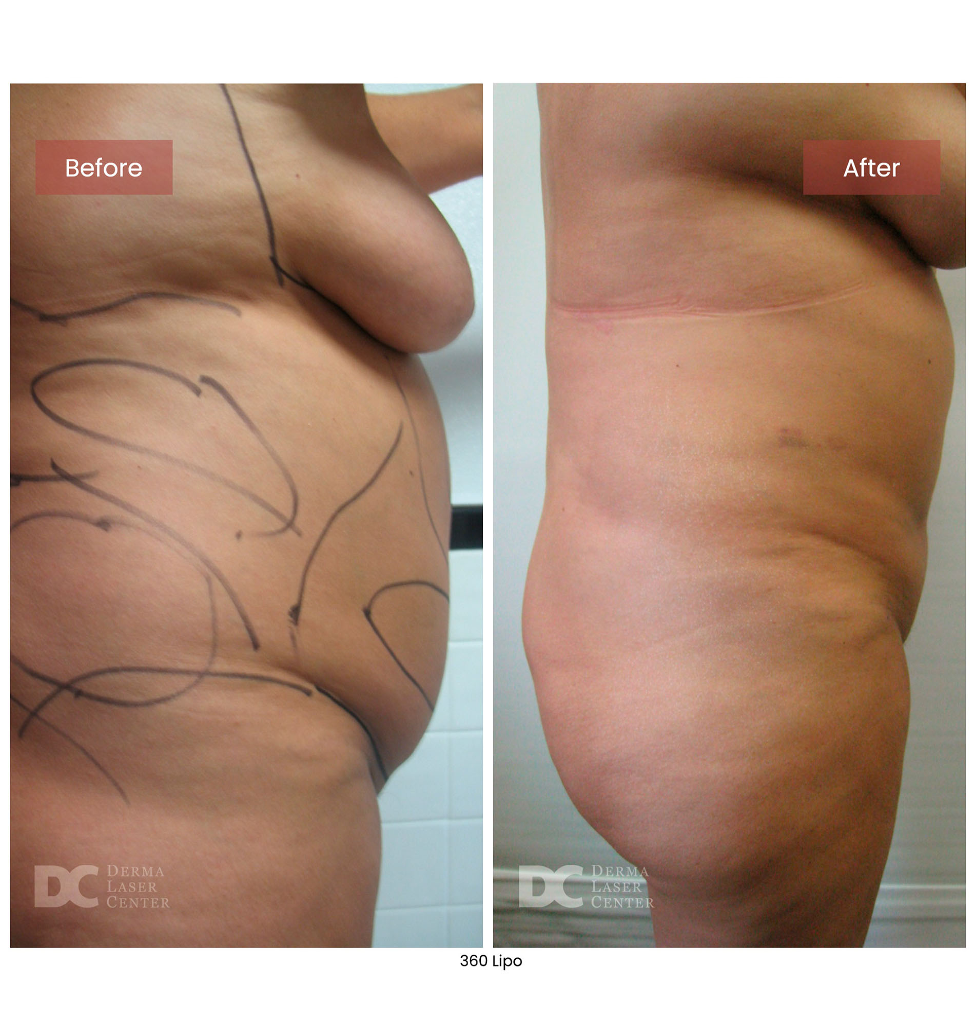 before after lipo 360 7