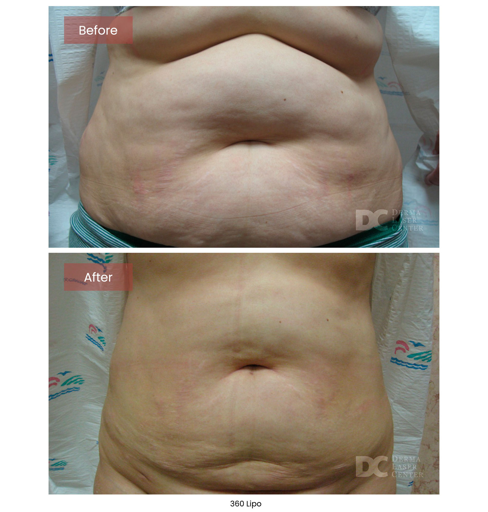 before after lipo 360 8