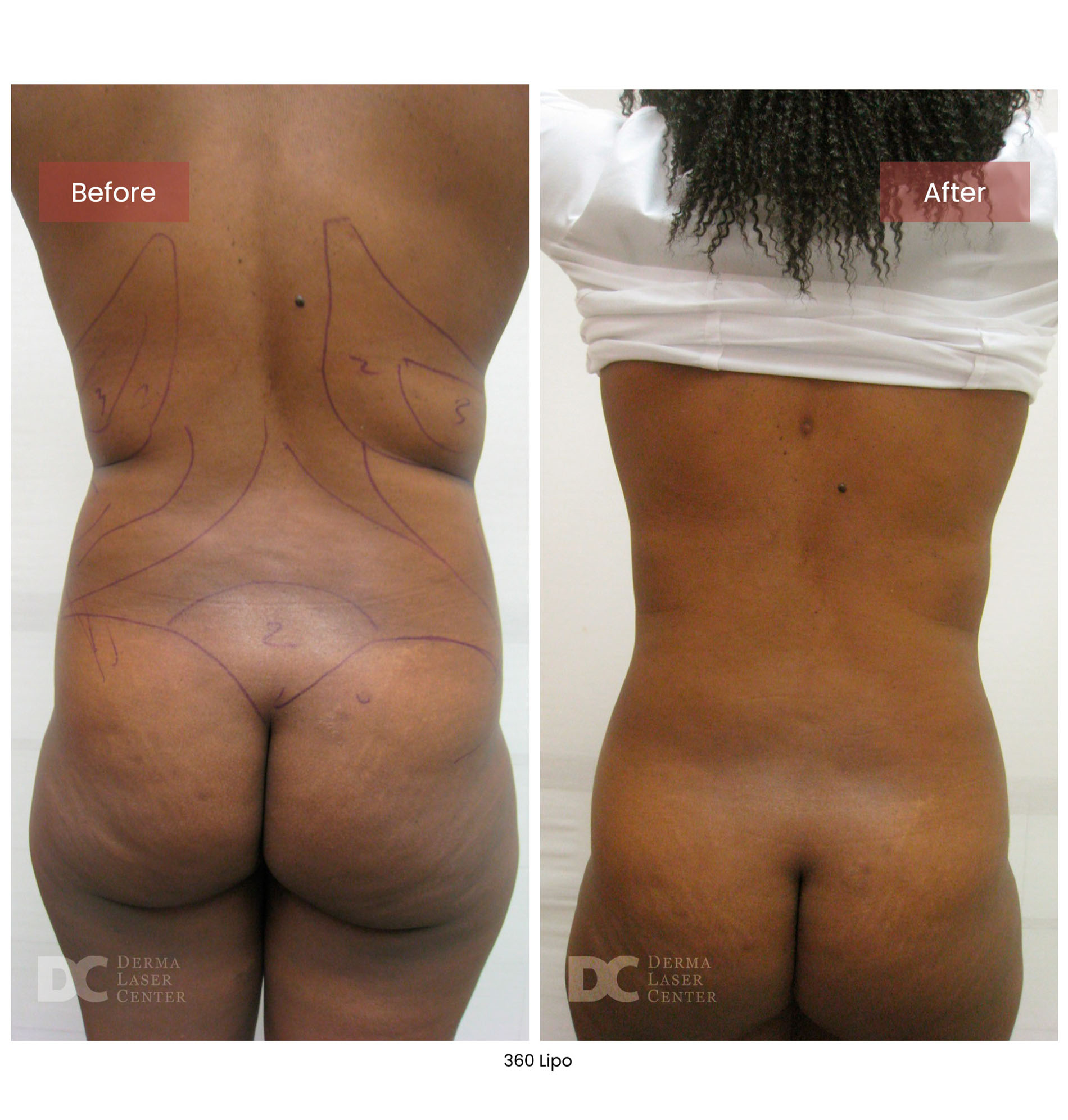 before after lipo 360 9