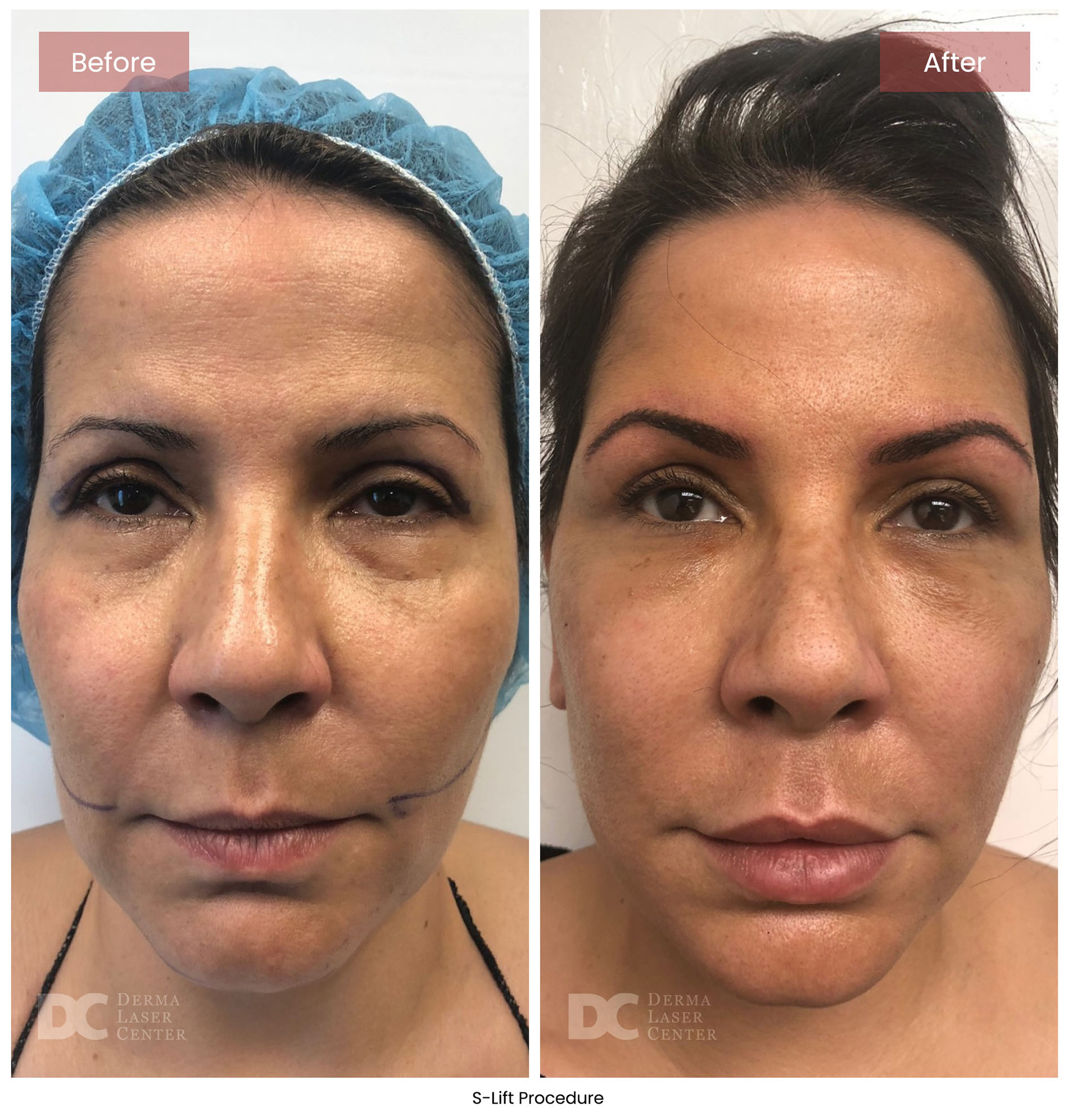 before after s lift mini face lift 1