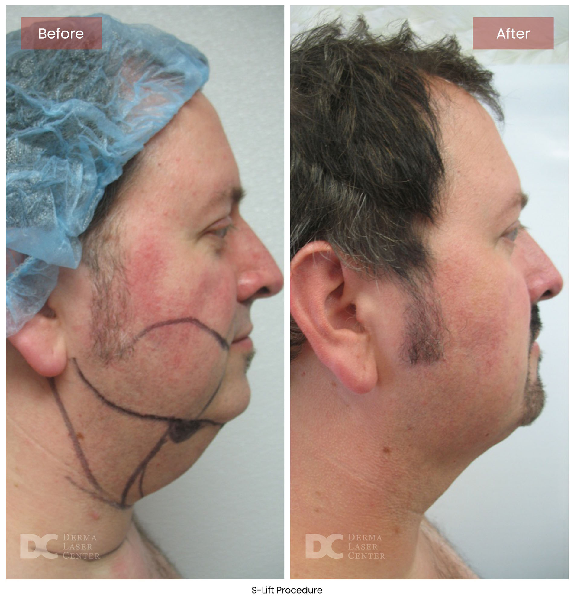 before after s lift mini face lift 10