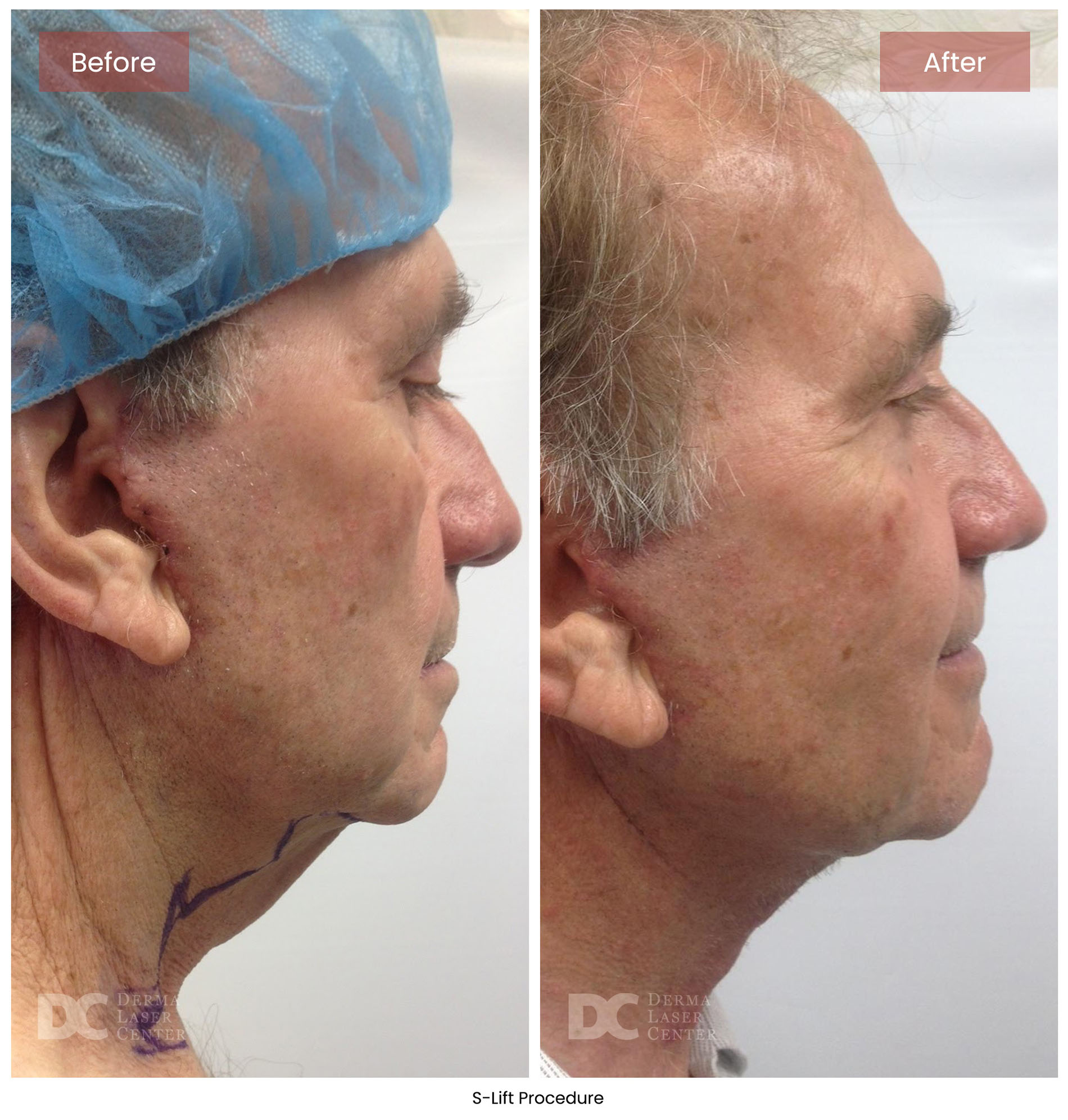 before after s lift mini face lift 11