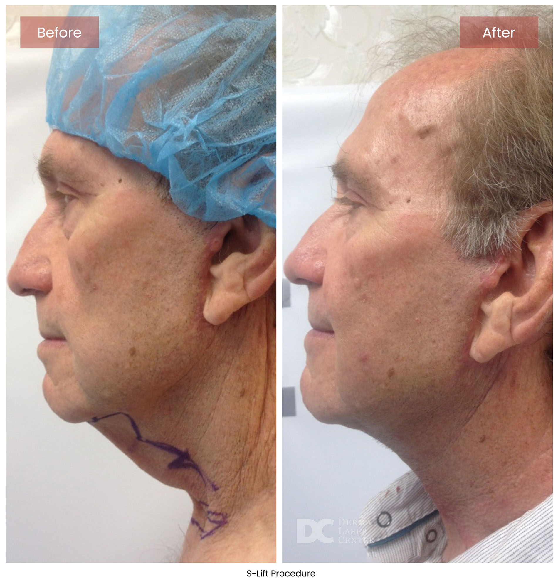 before after s lift mini face lift 12