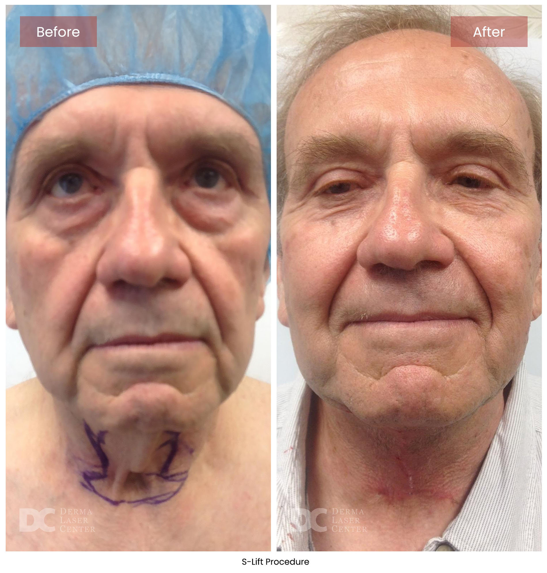 before after s lift mini face lift 13