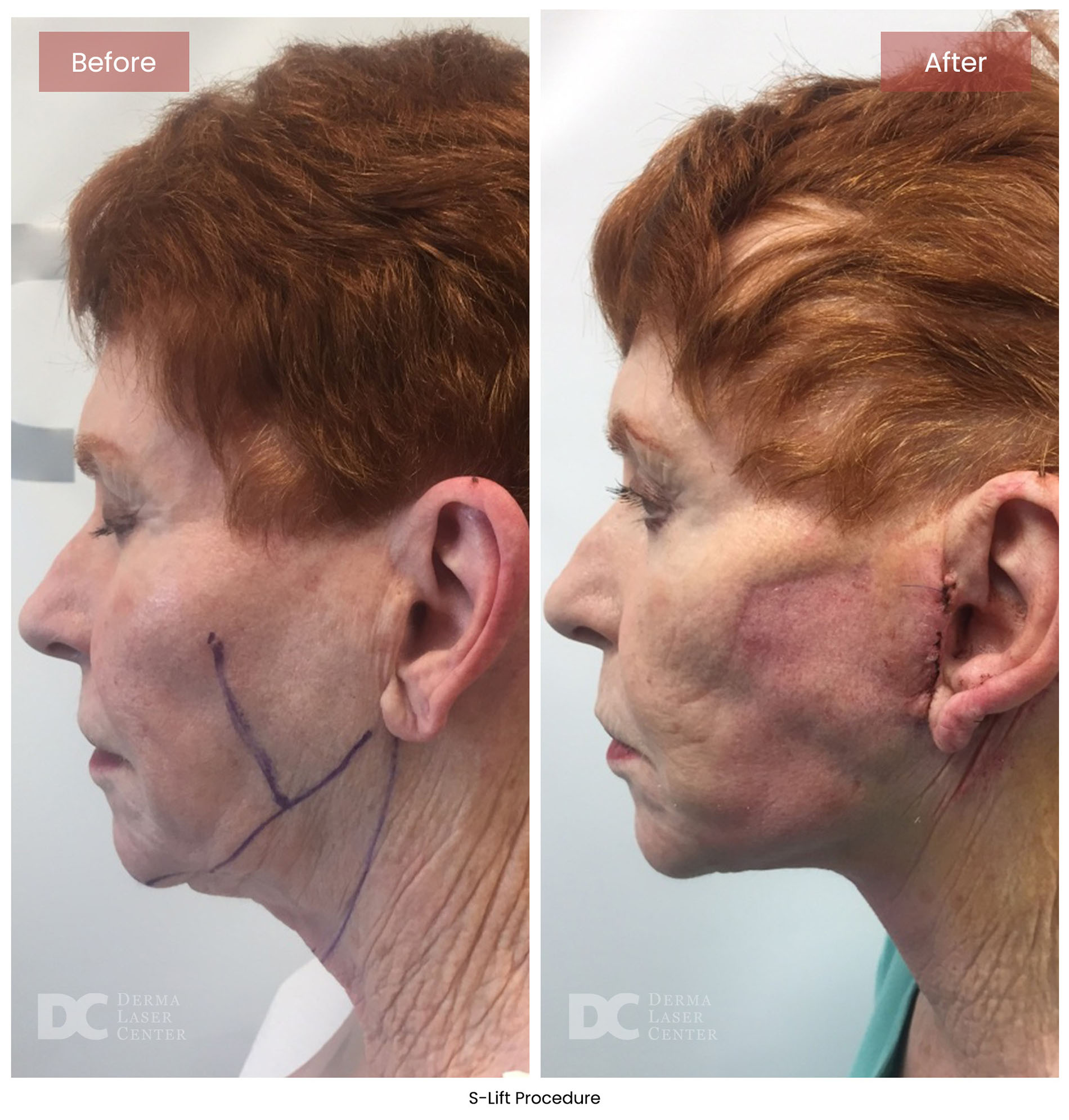 before after s lift mini face lift 14