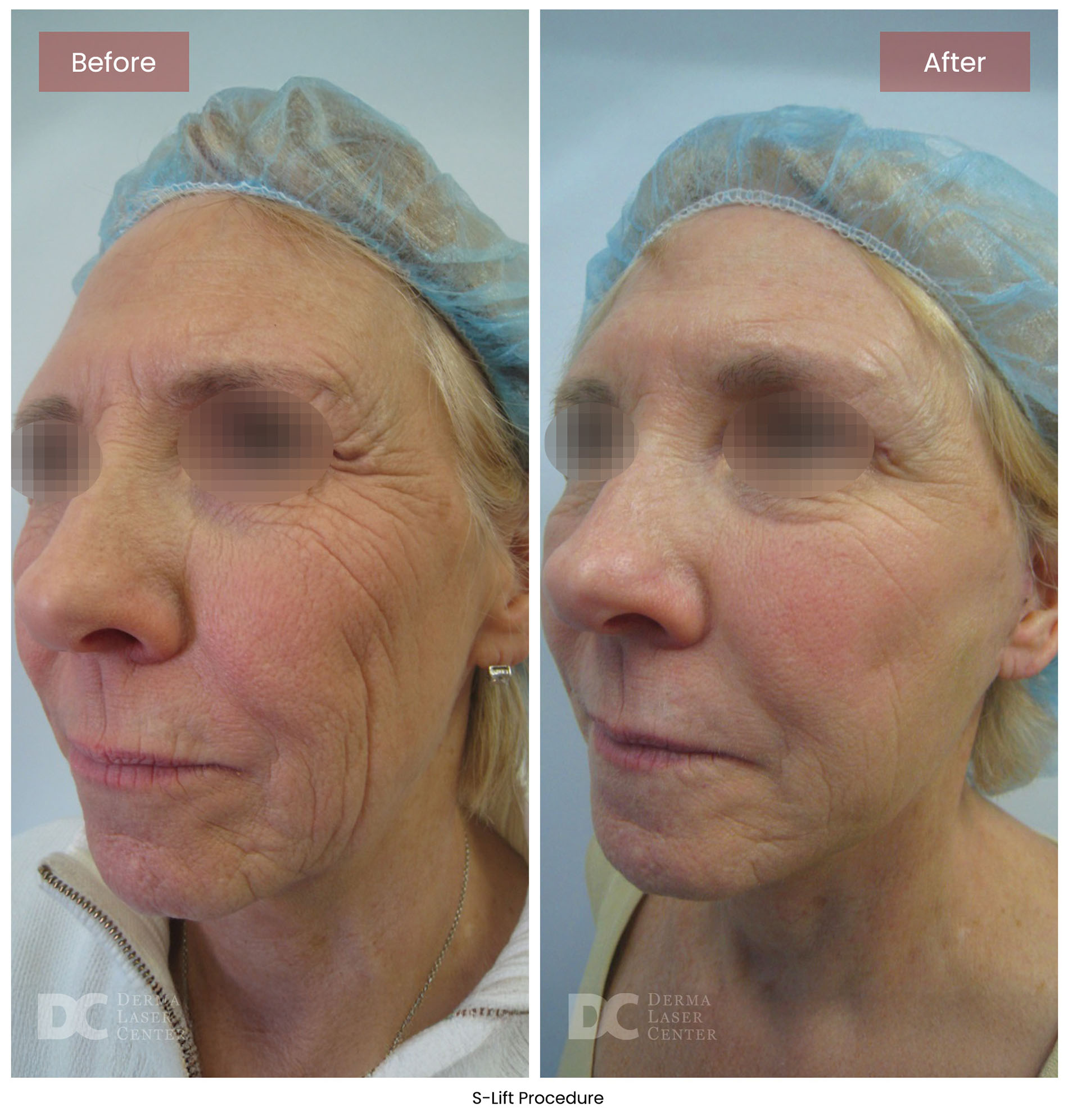 before after s lift mini face lift 2
