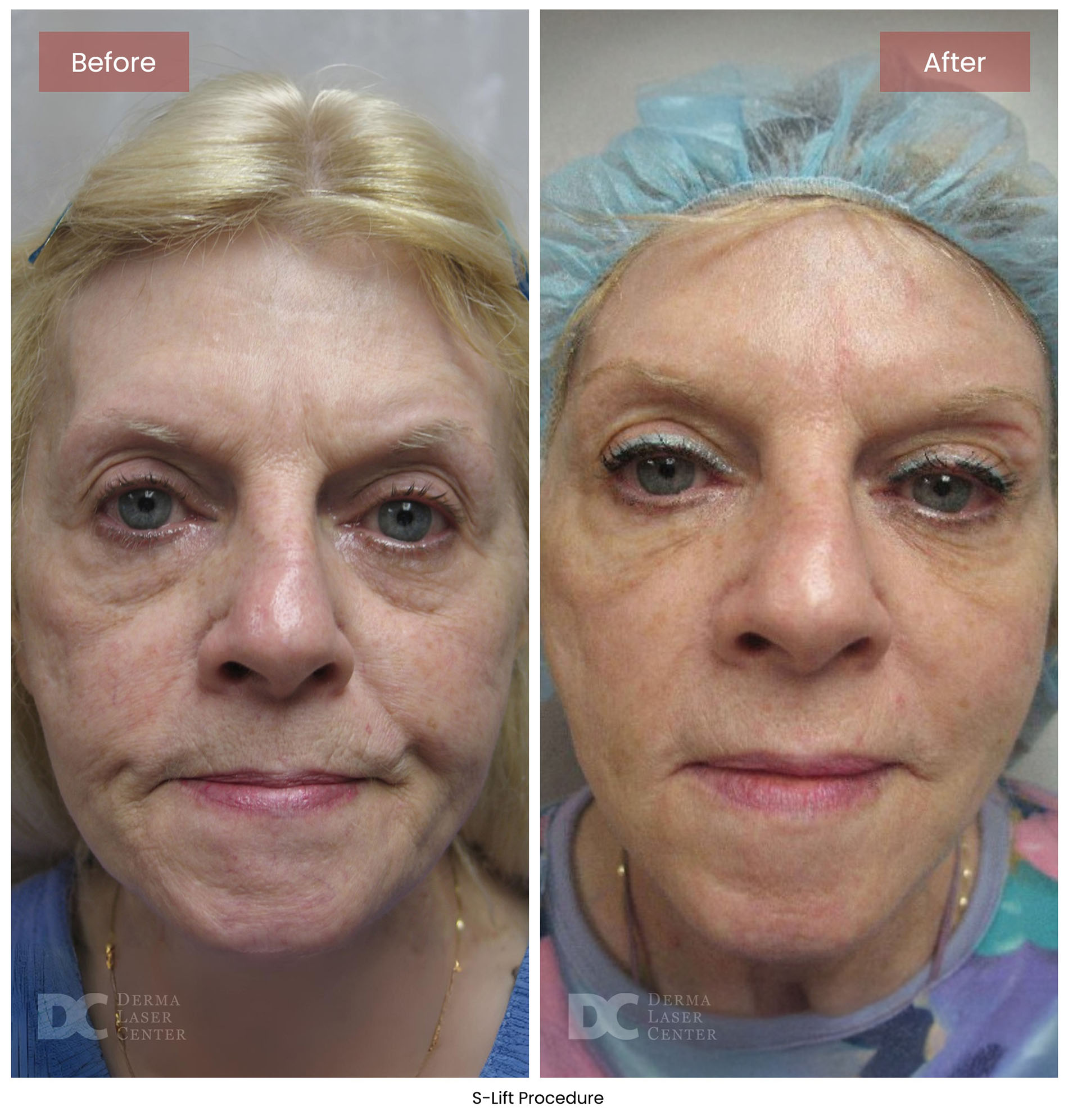 before after s lift mini face lift 3