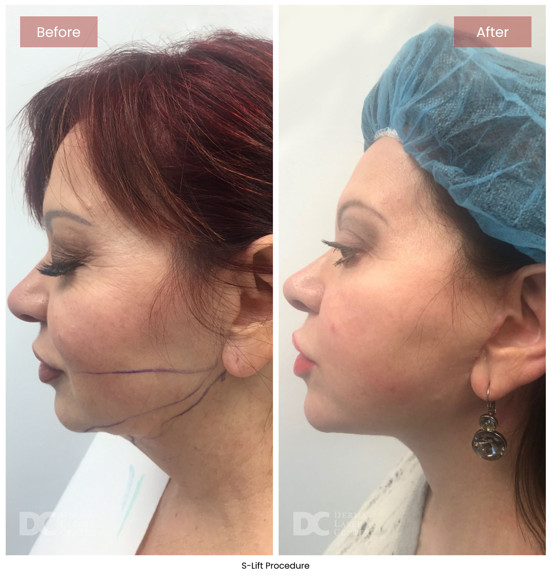 before after s lift mini face lift 4