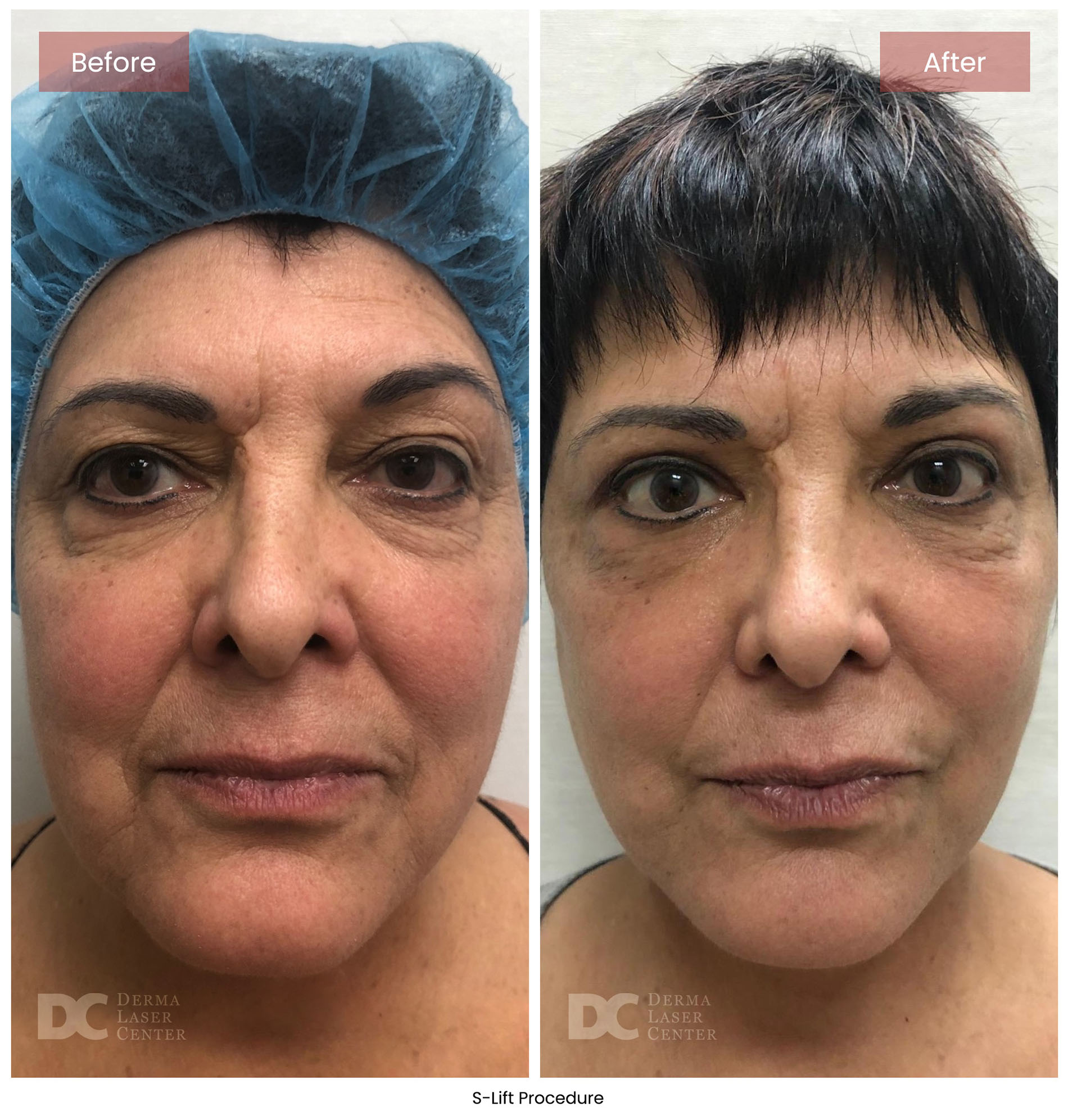 before after s lift mini face lift 5