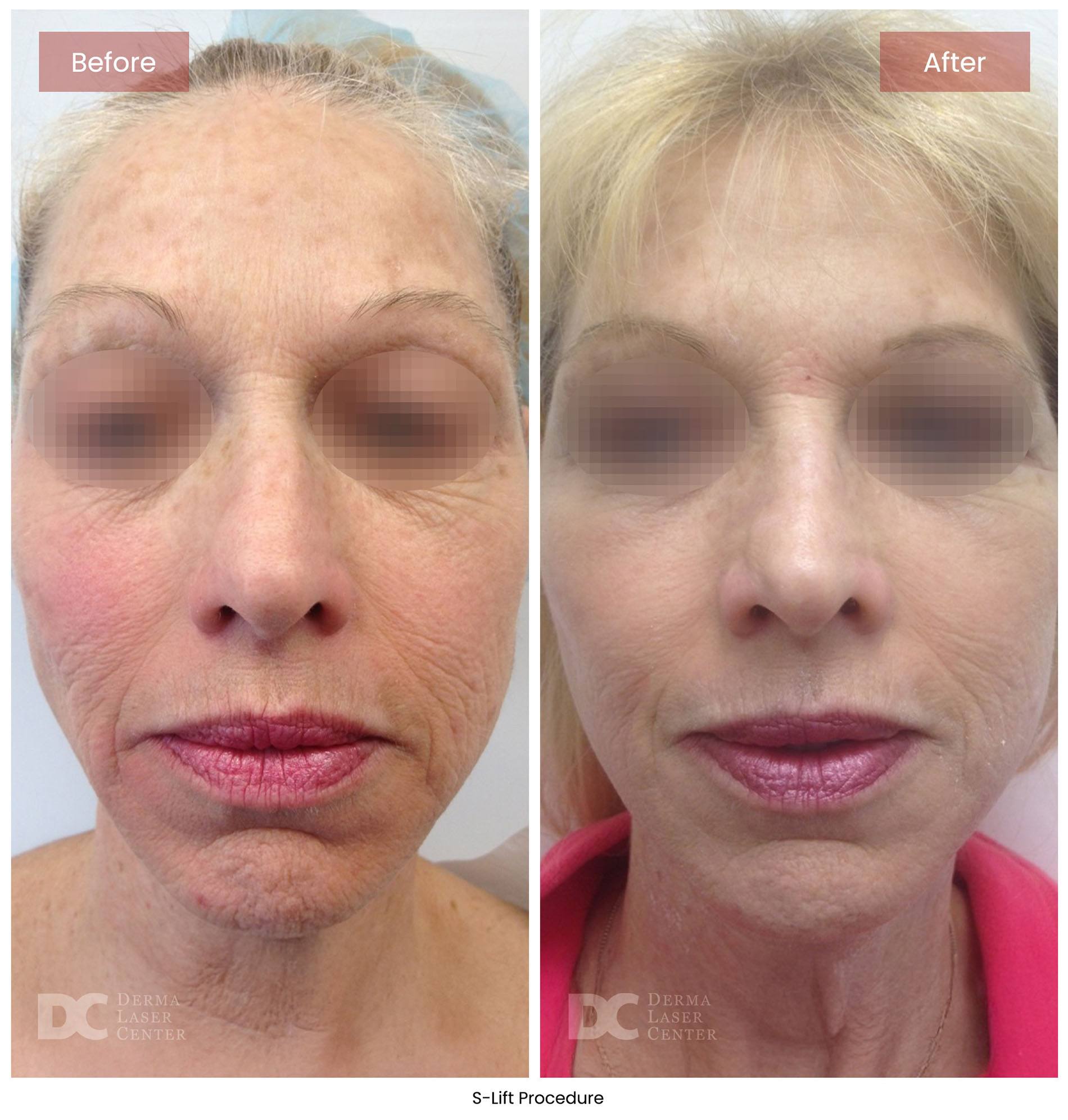 before after s lift mini face lift 6