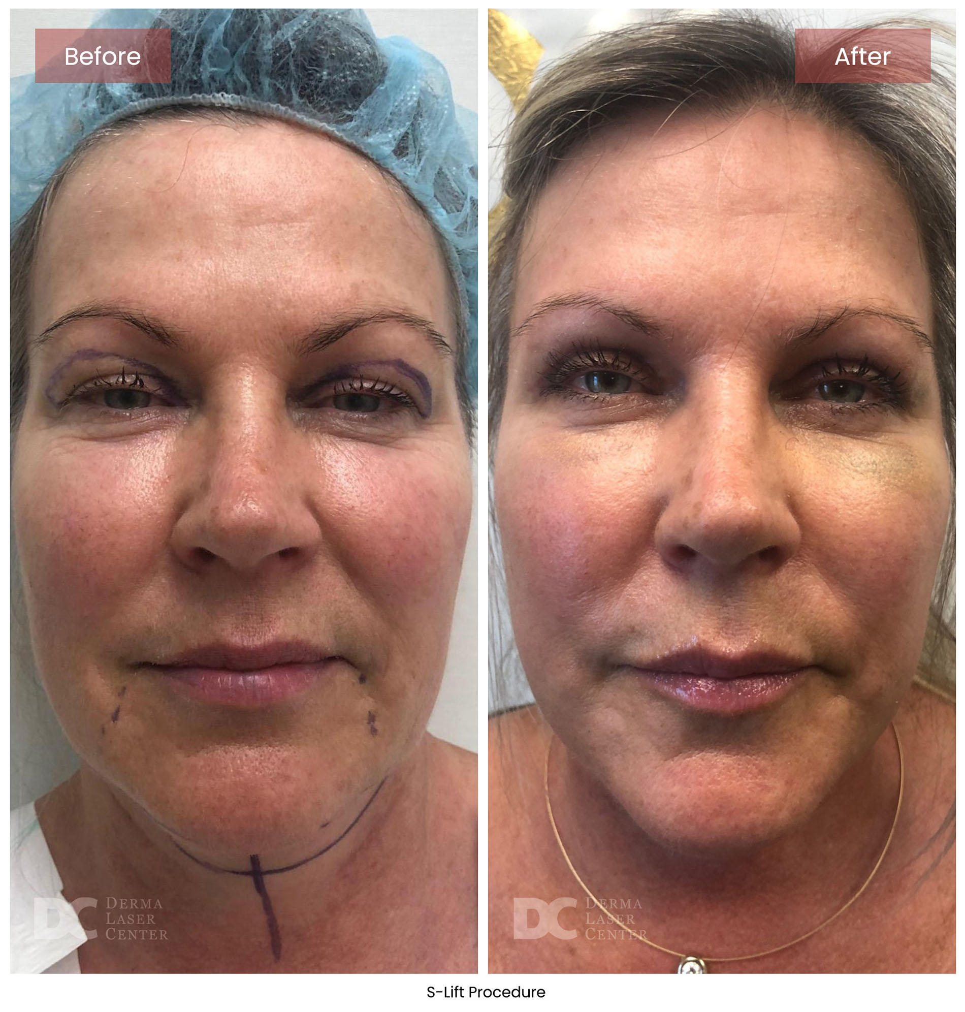 before after s lift mini face lift 7
