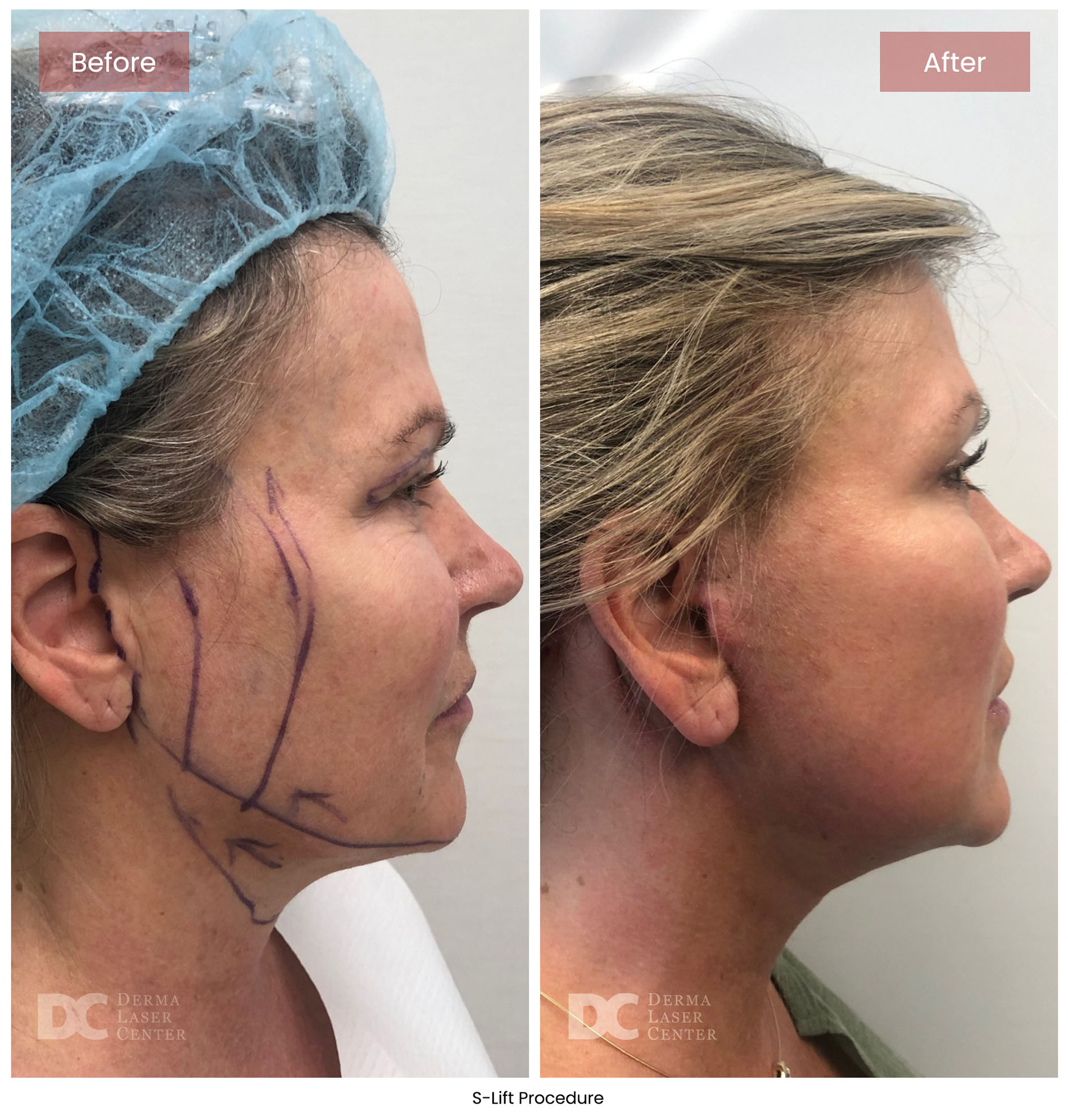 before after s lift mini face lift 8