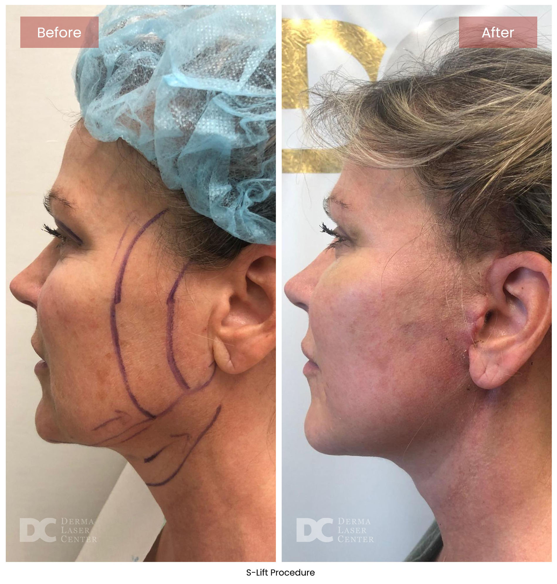before after s lift mini face lift 9