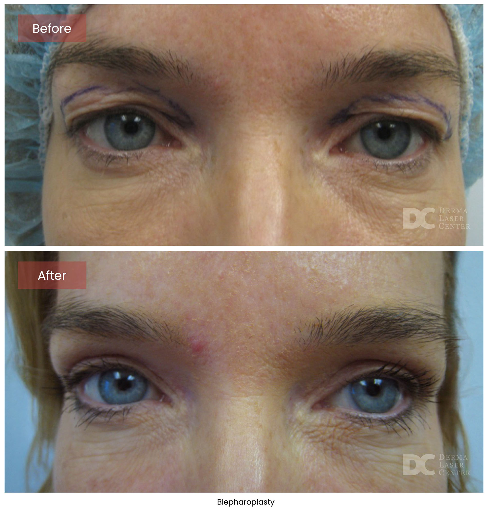 Blepharoplasty 1